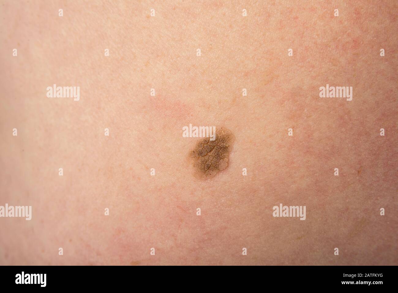 Menschliche Hautwarze auf einem Frauen-Bauch Stockfoto