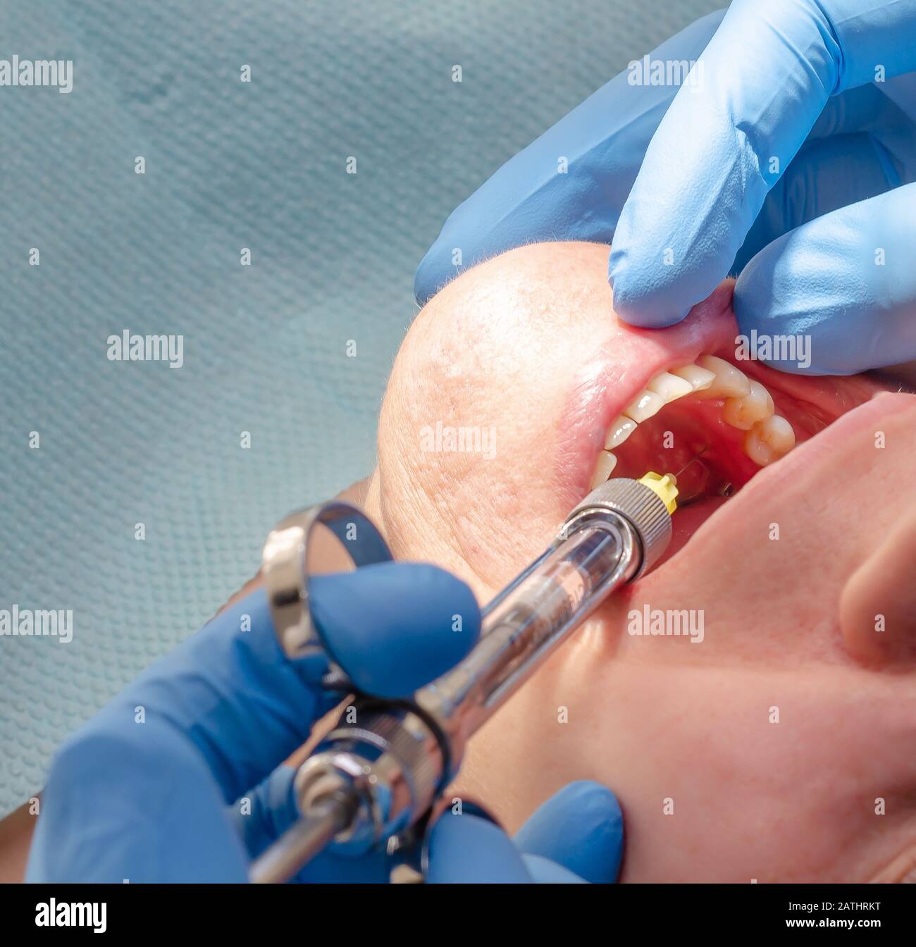 Der Arzt verabreicht dem Patienten in der Zahnklinik eine anästhetische Injektion Stockfoto