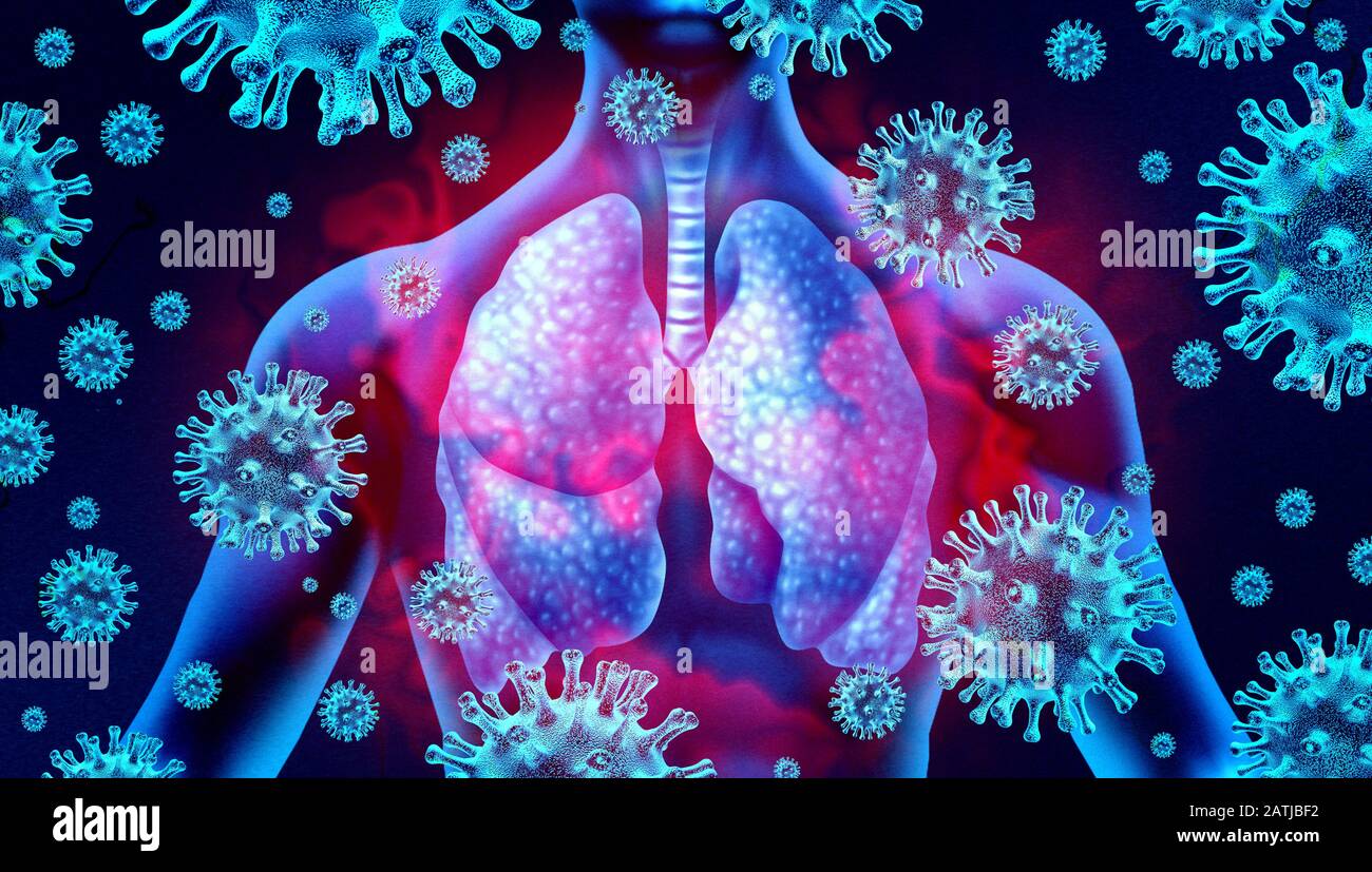 Lungenvirusinfektion und Coronavirus-Ausbruch oder Virus-Pneumonie und Coronaviren Influenza als gefährliche Grippe-Belastungsfälle als pandemic Medical. Stockfoto