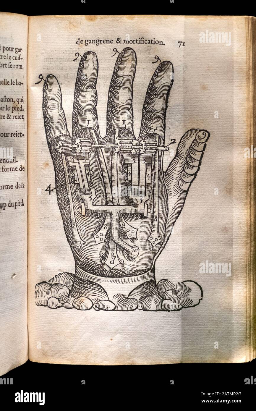 Ambroise Paré (1510 - 1590) französischer Chirurg. Seite aus dem Buch "der Weg, Wunden zu behandeln..." , 1552. Holzschnitt einer fiktiven künstlichen Hand. Stockfoto