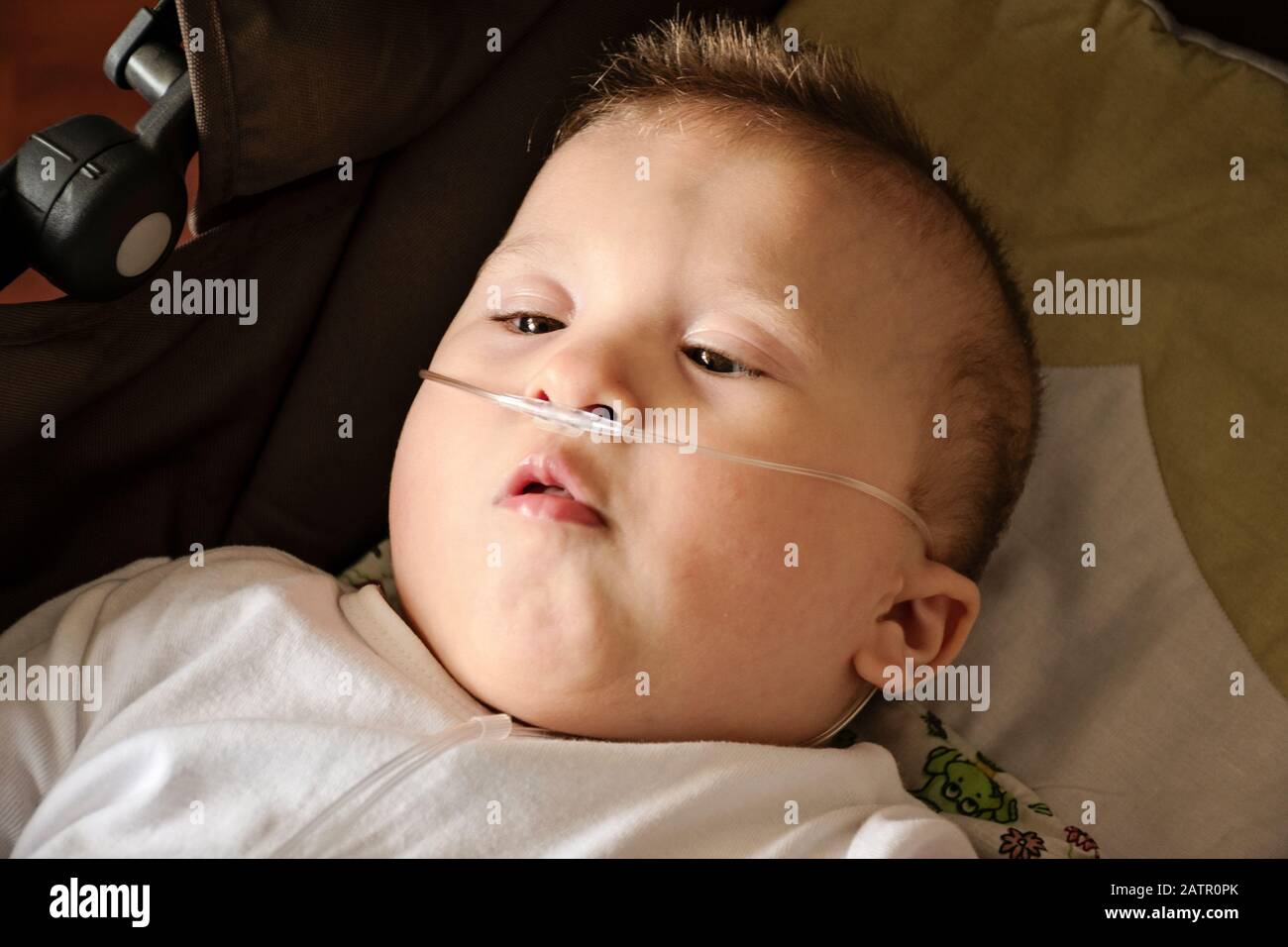 Baby Junge mit zerebraler Pläse erhält Sauerstoff über Nasenprongs, um die Sauerstoffsättigung zu gewährleisten. Nasenkatheter bei einem Patienten im Krankenhaus. Stockfoto