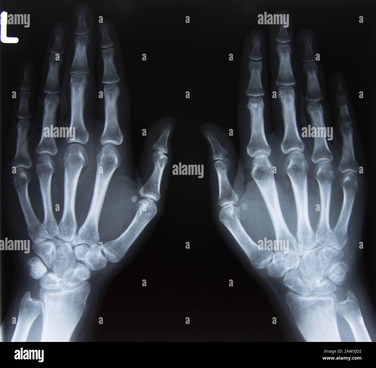 Röntgenbild Hand und Finger Stockfoto