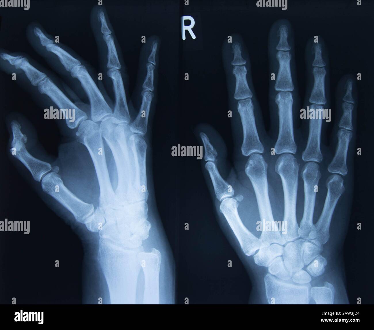 X-Rayed menschliche Hand. Röntgenaufnahme der Handknochen. Stockfoto