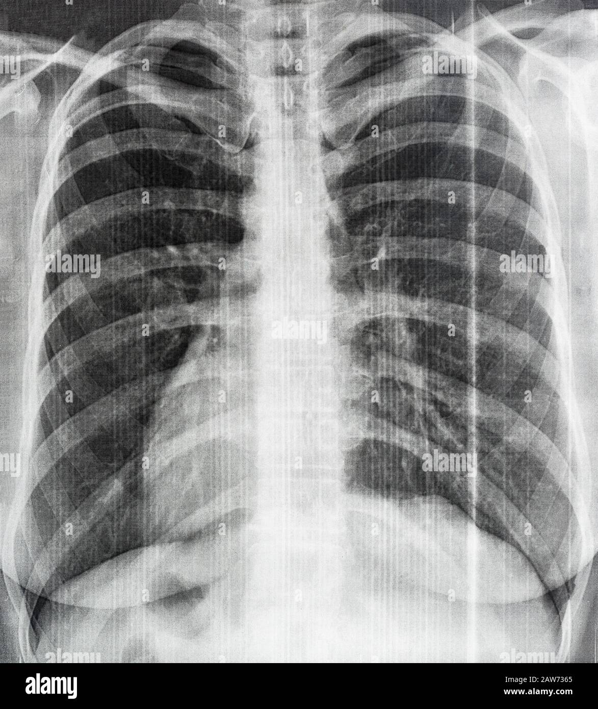 Pneumonie Virus Stethoskop Medizin Lunge Schnappschuss Nahaufnahme Stockfoto