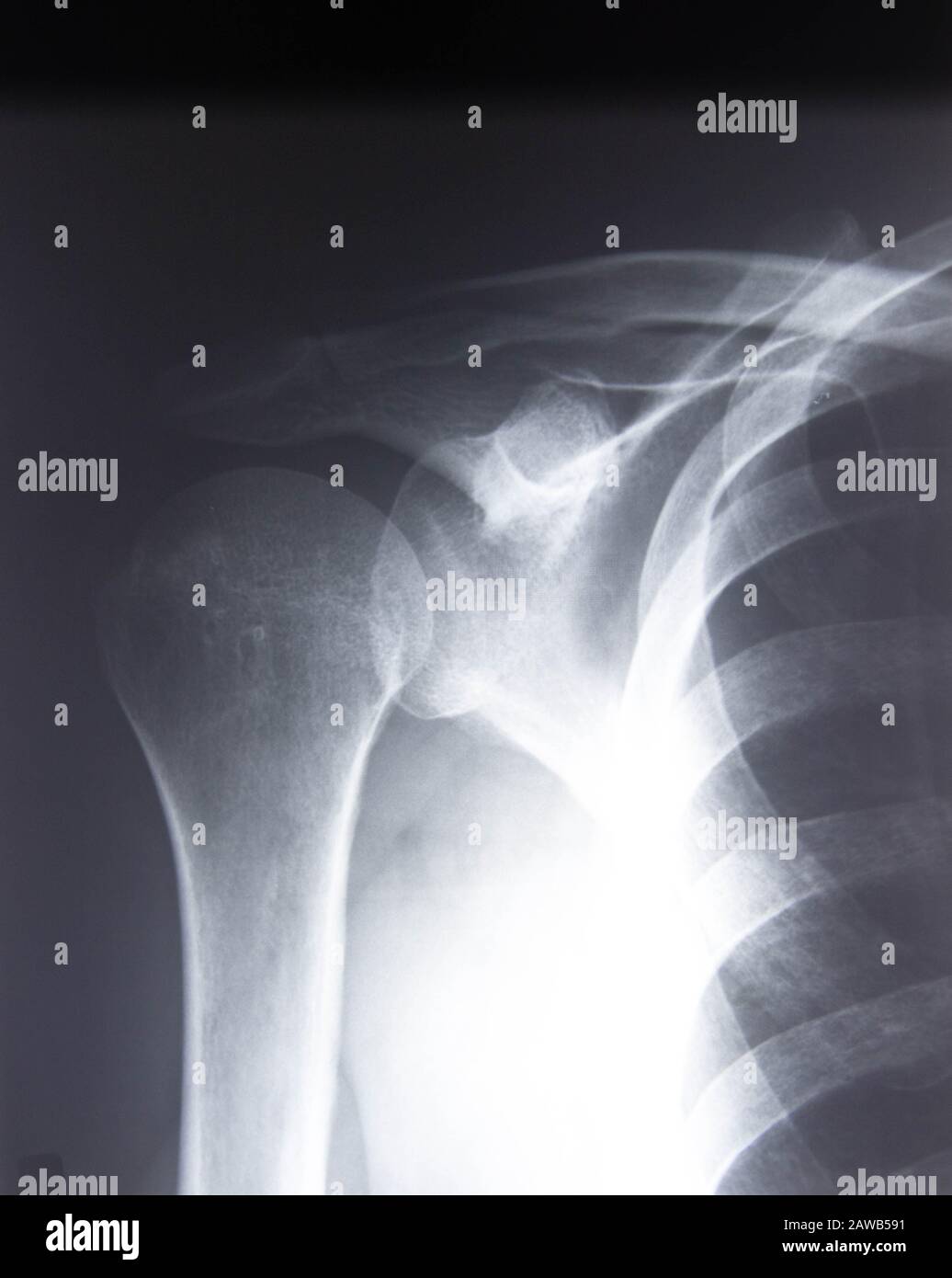 Film-Röntgenschulter-Röntgenbild zeigt degenerative Arthrose der Gluten- und Akromioklavikulären Gelenke Stockfoto