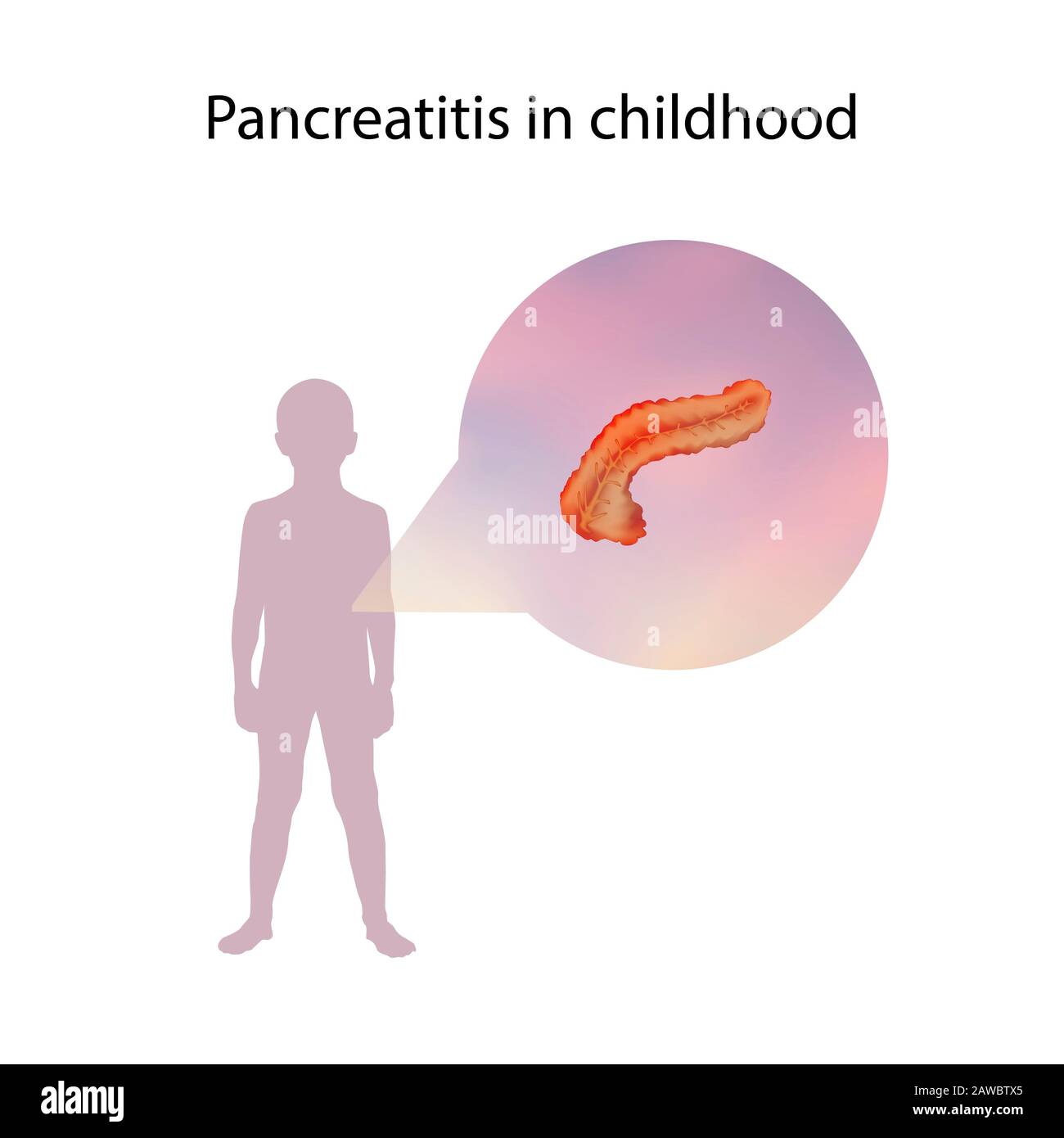 Pankreatitis im Kindesalter, Abbildung Stockfoto
