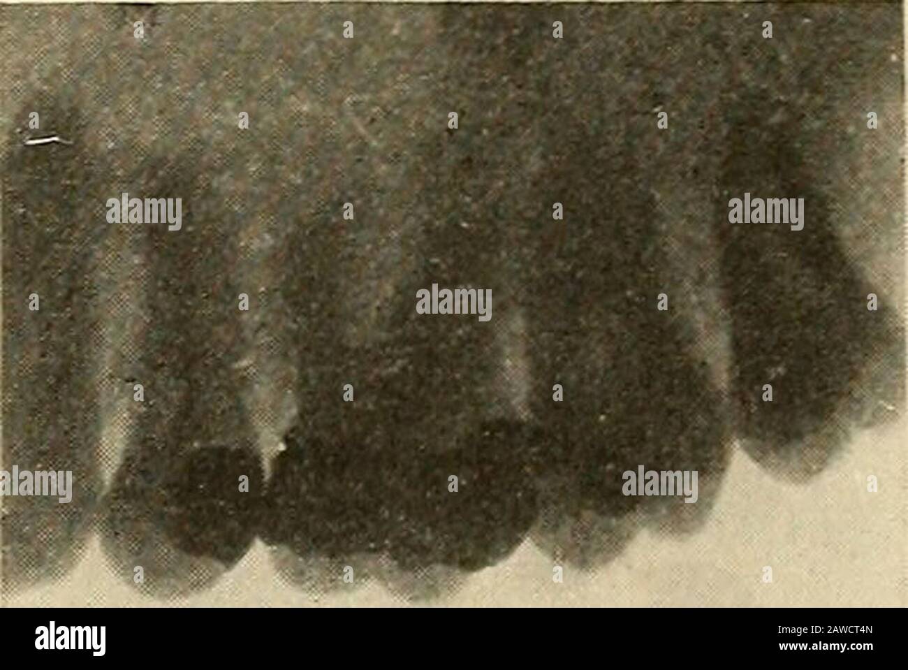 Orale Chirurgie; ein Textbuch über allgemeine Chirurgie und Medizin, wie es auf Zahnheilkunde angewendet wird. Abb. 118.-Root Cyst. Abb. 119.-TeethFROM Wurde Dieselbe Zyste entfernt, um die Höhle der Zyste mit der Mundhöhle fortlaufend zu machen. Die beiden beleidigenden Zähne werden extrahiert und die äußeren knöchernen und membranösen Wände wereremoved, wodurch die Öffnung so groß wie möglich wird, um die Mundhöhle und die Zyste Cavitykontinuierlich miteinander zu makieren. Itwould nicht wünschenswert sein, um Akavität dieser Größe nahe zu haben, bis die töchitekturale Rekonstruktion des Knochens aus Angst stattfand, dass theremight eine gewisse Ansammlung ist. Thecavity w Stockfoto