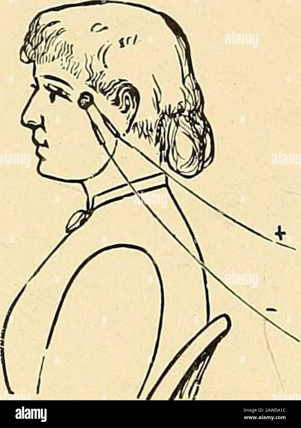 Der elektrotherapeutische Leitfaden oder tausend Fragen, die gestellt und beantwortet wurden. Der Elektrolyse von derivenden Geweben, wenn sie intelligent und richtig angewendet werden. Elektrolyse lebender Strukturen ist (außer trockene Epidermis und Knochen) sympathisch für schwache Kochsalzlösungen. Bei der aktiven Elektrode handelt es sich meist um eine teilisolierte Nadel, die am Minuspol befestigt ist. Mit dem anderen Pol ist eine große sur-face-Elektrode (gut benetzt) verbunden, die auf einem beliebigen Körperteil platziert werden kann.Die Nadel wird dann in das Wachstum eingeführt und der Kreislauf geschlossen, und die Elektrolyse beginnt sofort zu erfolgen Stockfoto