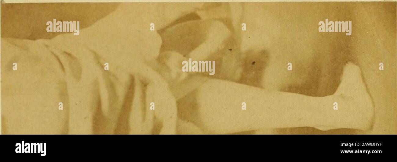Bei der Heilung von Schlägerfuß ohne Sehnen zu schneiden: Und bei bestimmten neuen Methoden zur Behandlung anderer Deformierungen . verursachen erhebliche Schmerzen im äußeren Teil des Schrittes, über dem Kalkanuboidgelenk und der Muskulatur des Flexorbals Digi-Torum. Dieser Schmerz ist sehr schwer, sie ist nicht ableitend, wie sie es vor kurzer Zeit könnte, und sie ist von einer unbeholfenen und unbequemen Lahmheit beherblich. Der Fall ist ein erworbener Valgus des Advanceddegrades. (Platten iii. Und iv.) Die dritte Figur, S. 105, ist der Umriss dieses Fußes. Ich habe die posteriore tibielle Sehne mit aber kleiner Kraft geliefert und sie machte einen Spaziergang Stockfoto