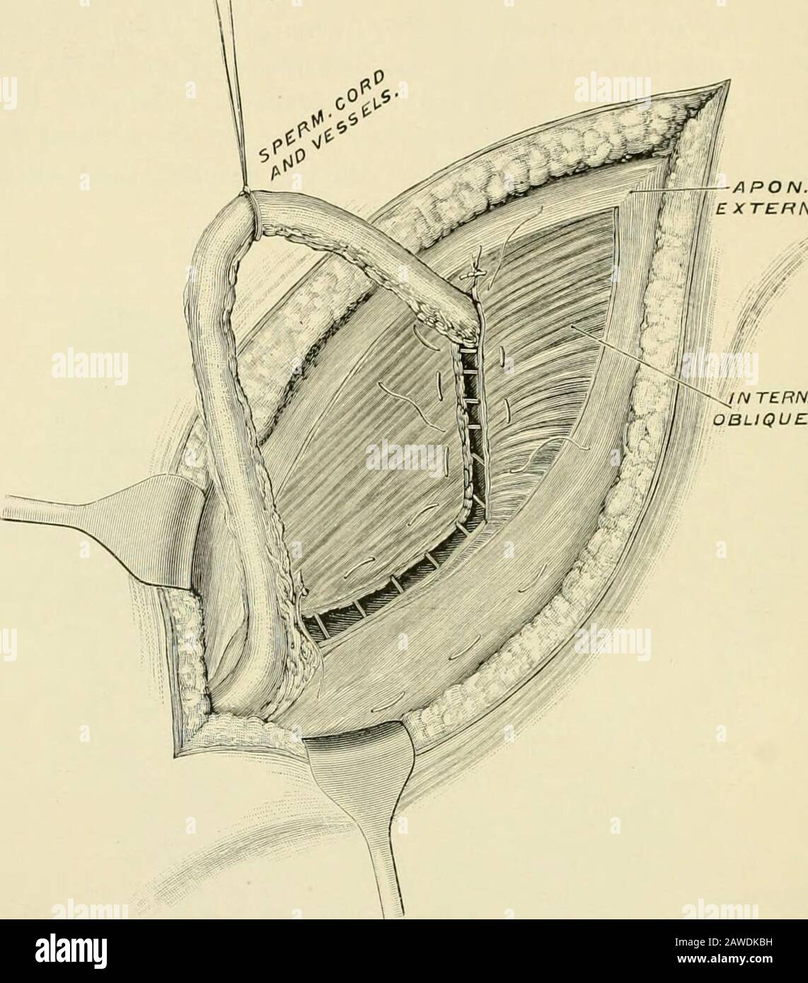 Operative Chirurgie. Abb. 113-T.-Operation zur radikalen Heilung von Leistenhernie, Halsteds-Methode. VeinsJiiiatured and Resected. Mesokord nur in seiner Mitte gerissen. Silberne Nähte eingesetzt, eine über und vier unter der Schnur. Poupartes Ligament der Rand des Rektus von der Symphyse zu einem Punkt, der der äußeren Grenze des transplantierten Schnabels entspricht (Abb. 1143). 924 OPERATIVE CHIRURGIE. HIE Remarks.-Diese Änderung, obwohl ursprünglich eine ergänzende Methode für Ilalsteds, kann auf andere angewendet werden, in denen der Kanal freiberuflich verlegt ist. Die Ergebnisse - In bisher 30 Fällen, die von keinem Rückfall berichtet wurden, sind in Anspruch Stockfoto