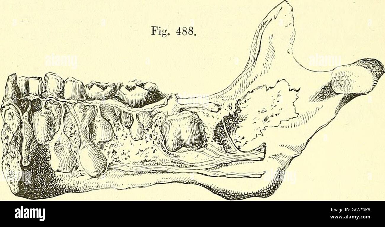 Quains Elemente der Anatomie . entsprechender Milchzahn. Der endständige Zahn wird durch eine knöcherne Trennwand vom Nilkenzahn getrennt, der ebenso wie die Wurzel des unmittelbar darüber liegenden Milchzahns absorbiert wird, wenn die Krone des endständigen Zahnes durch das Zahnfleisch steigt. Wenn dieser weit genug gerodet ist, löst sich der Milchzahn auf, fällt aus oder wird entfernt, und der Permanentzahn tritt an seine Stelle. Die Aufnahme der Zahnsubstanz beginnt an den Enden der Fänge in ornear und geht nach oben, bis nichts als die Krähe übrig bleibt. Zuerst wird der Zement angegriffen, dann das d Stockfoto