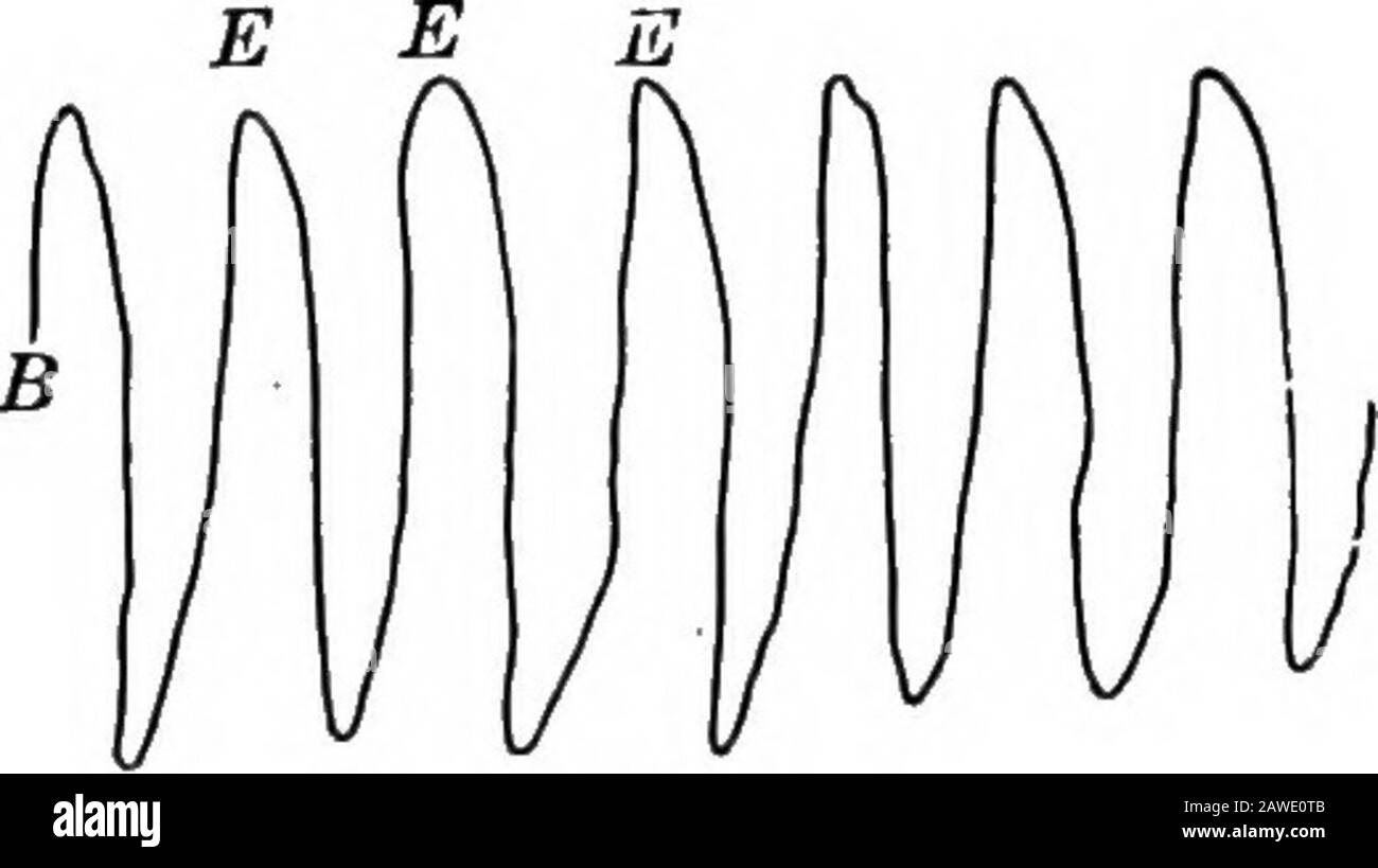 Angewandte Anatomie und Kinesiologie, der Mechanismus der muskulären Bewegung. III Allenfalls T1 l l i r-1 i i i i i i i i i I I-i 11 ii l Subjekt, HJuli U, 1993. T-T-l i i i Ich Arbeite ii Abb. 143.-Grafische Aufzeichnung der Atembewegungen: B, Atmungskurve; T, Zeit in Sekunden; /, Inspiration abgeschlossen; E, Exspiration abgeschlossen. Erfolgt durch allmähliche Veränderungen in der Entspannung der inspiratorischen Muskeln, die durch den gesamten Atemzyklus wirken, Inspiratorik und Entspannung auf die gleiche Art und Weise bei der Exspiration. Das Zentrum von Thenerve steuert die beiden Bewegungen und den Wechsel von einem zum anderen so viel wie ein Mo Stockfoto