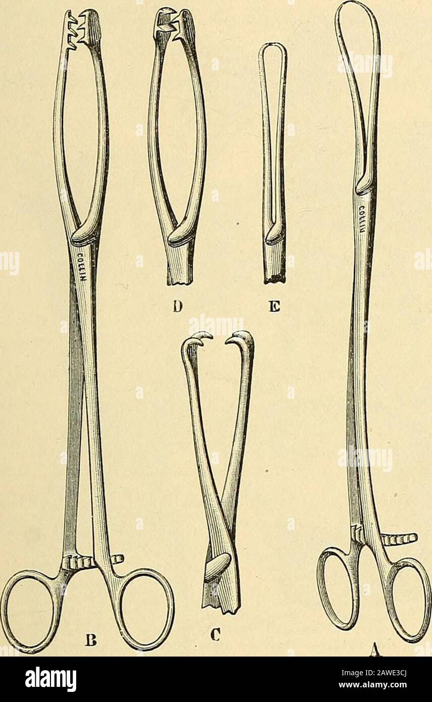 Traité de gynécologie clinique et opératoire . tsoh. (Archiv F. Gyn., 1887. BD II HEft 3, S. 362. - Terrier {Revue de Chirurgie, Mai 1888) - Strotz. Eine Modifizierung des DesUterusexrührs pro Vagin. (Cenlr. F. Gyn. Nr. 50). - Abel. [Derliner kl. Wochensch.1889, Nr. 30). 5 Voir pour lhistorique: Rochard. Histoire de la Chirurgie Franc, au XIXe siècle, S. 265-267. - Ch. Gustave Hesse. Mémoire pour servir à lhistoire de lextirpation delutérus [Revue médicale, 187, 2e Band, S. 67). - Velpéau. Nouveaux éléments de méd.opératoire, Paris, 184, t. IV, S. 426. - Gomet. Lhystérectomie vaginale en F Stockfoto