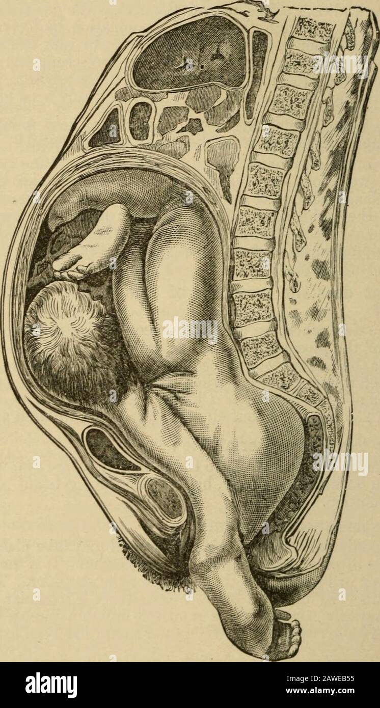 ObstetricsA Handbuch für Studenten und Praktiker . ere sind zwei Möglichkeiten, um sie zu beenden - nämlich durch spontane Version oder durch spon-taneous Evolution. Was ist spontane Version? Dies kann nur bei einem lebenden Fötus auftreten und kann während der thelatteren Schwangerschaftswochen oder nach Beginn der Arbeit stattfinden. Es handelt sich um den Substitutingdes Scheitelpunkts oder der Breute über dem Muttermund für die Schulter. Die Probablekause dieses sehr glücklichen, aber seltenen Vorkommens ist eine unregelmäßige Uteruskontraktion, und diese Beendigung wird nahezu unmöglich, nachdem die Membranen zerplattet sind und der Liquor Amnii ha Stockfoto