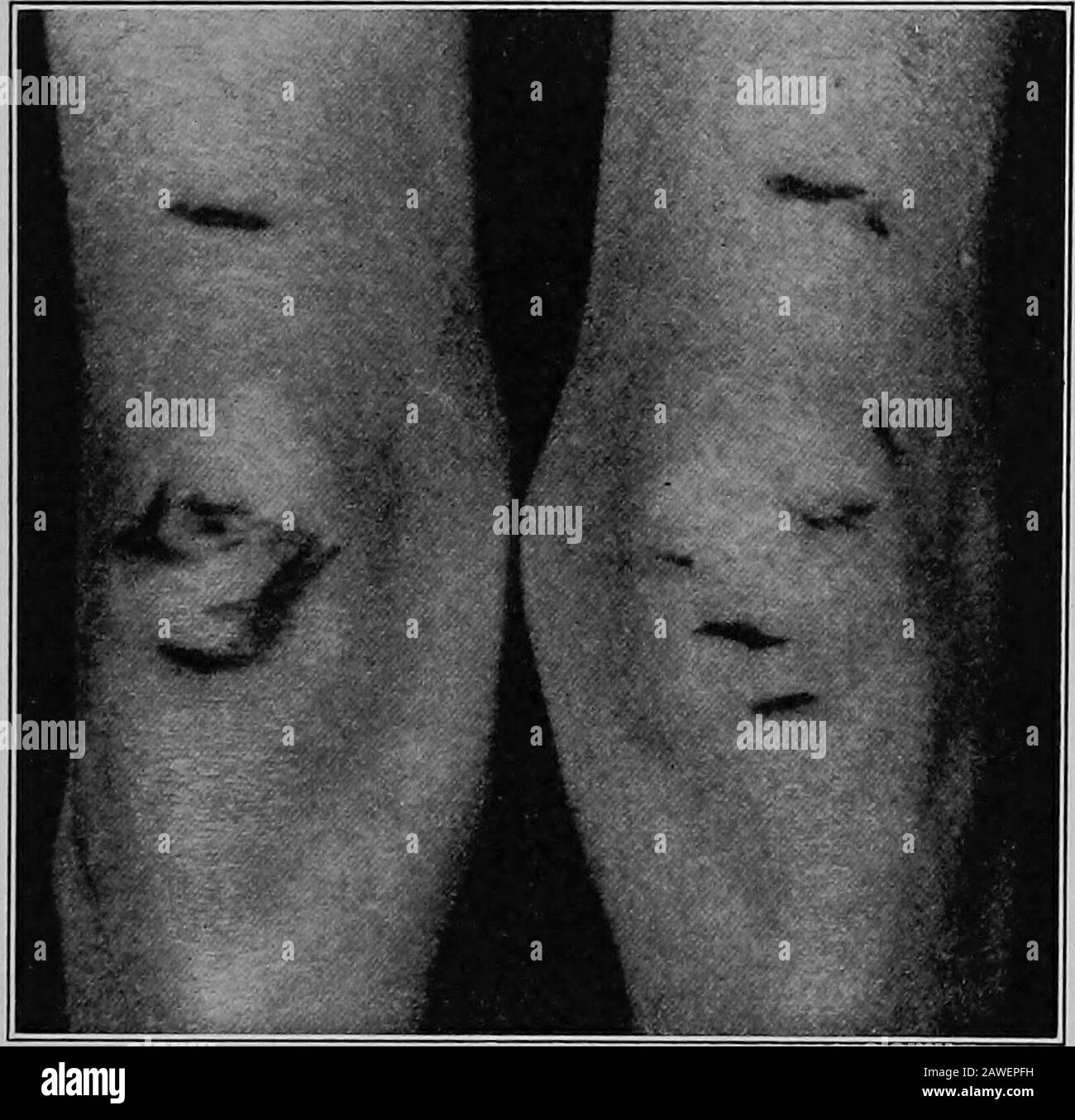 Klinische und pathologische Unterlagen .. . E leg es gab in allneunzehn dieser Narben, unregelmäßig platziert, das niedrigste war an einem H-Typhoidfieber und Anderen Exanthemata, zweite Ausgabe, 1909, S. 177,56 Johns Hopkins Hosp. Bull, V, 19. Digitalisiert von Microsoft® PHILLIPS: HAUTAUSSCHLÄGE IM TYPHUSFIEBER 9-Niveau mit der Spitze des inneren Mälleolus, der höchsten 14,5 cm über diesem Punkt. Sie lagen quer und variierten in der Länge von 1 cm bis 3 cm. Die durchschnittliche Breite der Striae betrug 9 cm. Das Zentrum der Patella, das sich quer ausdehnte, war ein Teil dieser Streifen, 2,5 cm lang, 0,2 Stockfoto