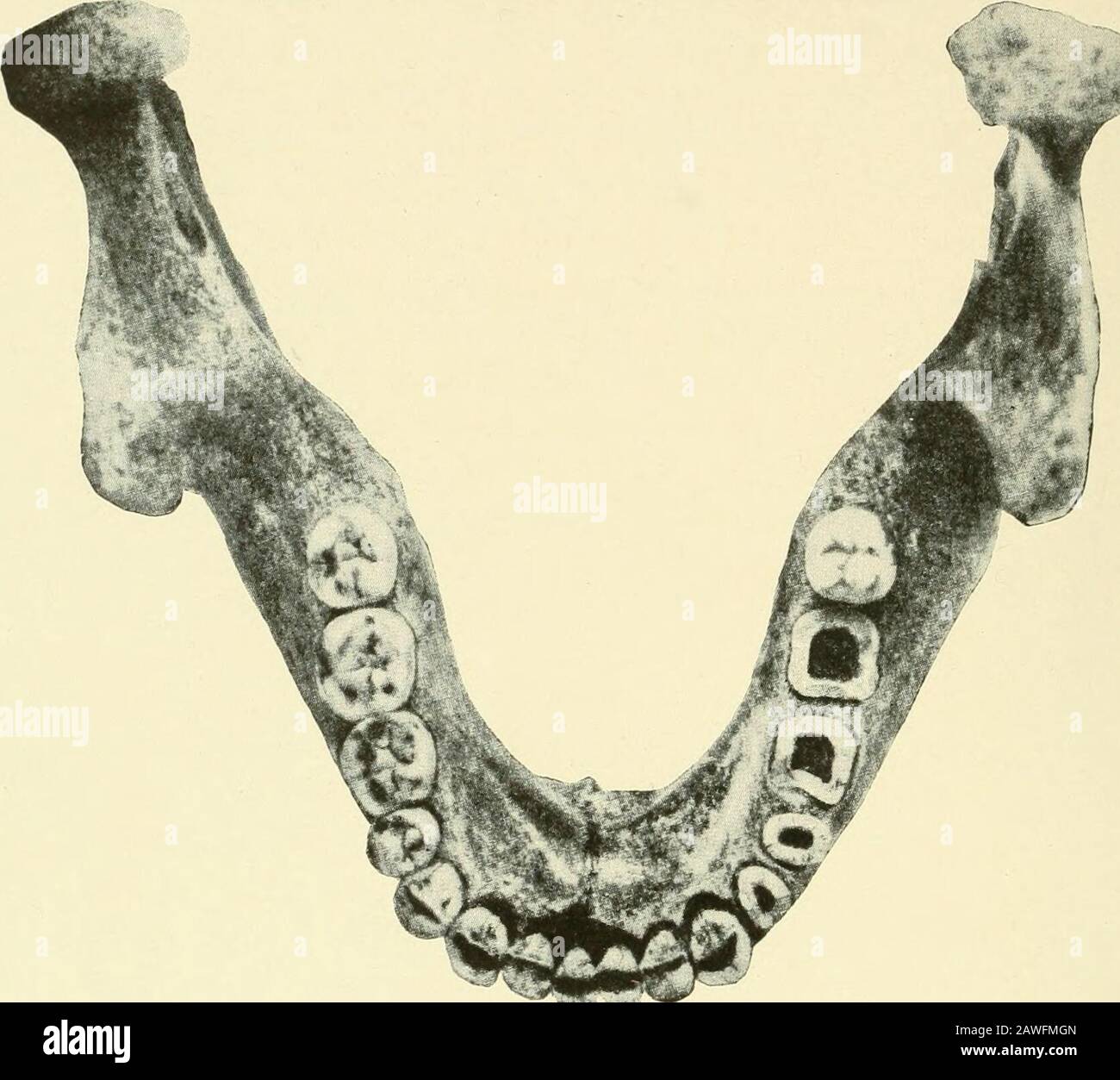 Jahresbericht des Vorstands der Smithsonian Institution . OT mit Across gekennzeichnet. Nach Schoetensack, der Unterkiefer des Homo Heidelbergensis, Taf. II, Leip-zig, 1908. Vielleicht ist die erste Sache, die Aufmerksamkeit erregt, das Fehlen eines Kinn (pi. 13). Die Region der Symphyse ist etwas Gorilloid, während der aiszende Ramus eher den Gibbon andeutet. Theteeth hat jedoch einen deutlich menschlichen Stempel, nicht nur in ihrem generalen Erscheinungsbild, sondern auch in einem Größenbereich, der größer ist als der Durchschnitt, aber kleiner ist als in Ausnahmefällen, die beispielsweise bei Den Aus-Talians zu finden sind. O Stockfoto