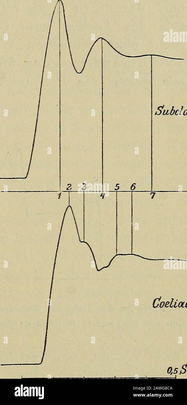 Die Unterteilung des Pulses und der ihre Ergebnisse in gesunden und kranken Zuständen . Subclavia Coeliaca o.SSEC. Abb. 71.Verso an der Leiche. Drucksteigerin Subclavia und Coeliaca in Folge Blut-eintrittes aus einem Reservoir in der Aorta.Vergr. %. Coeliaca o, 5 USD EE. Abb. 72. Verso an der Leiche. Druckschwankung im Subclavia und Coeliaca auf der Ergung einer Bergwelle im Anfangsstück der Aorta. Vergr. 9/4. Manometern ist ein eigenthümlich trepenförmiger, wie Abb. 71zeigt. In derselben bedeutschen die beiden 1, 2 die beiden der Erstenzentrifugalen Welle zugehörigen Stufen bezw. In der subc Stockfoto