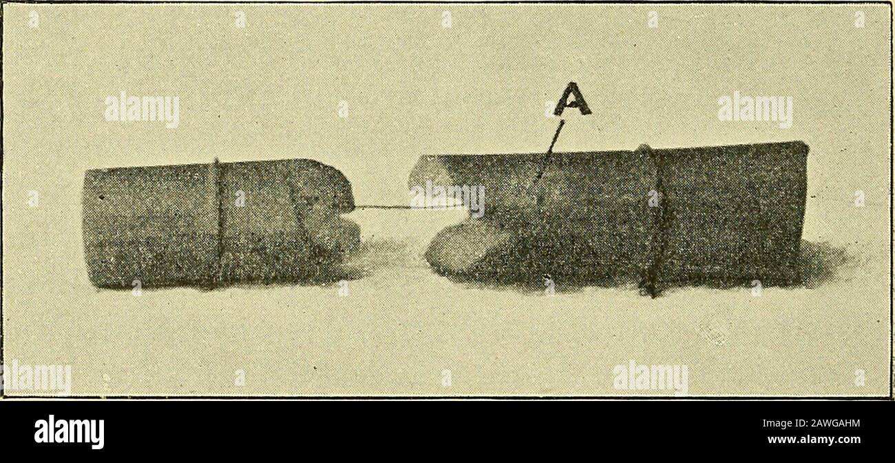 Wunden im Krieg: Der Mechanismus ihrer Produktion und ihrer Behandlung. Die Bruchstücke, in die der kompakte Knochen reduziert ist, können in drei Gruppen unterteilt werden: Feine Knochendebrisierungen durch tatsächlichen Kontakt mit der Kugel; kleine Splitter bis zu einer Länge von 1,5 Zoll, die aus der Ausgangsseite der D 5-GRAD-WUNDEN IM KRIEGSKNOCHEN entstehen; Und größere Bruchstücke, die normalerweise auf der Eingangsseite des Schaftes zu sehen sind. Coler gibt an, dass die Intensität des Splinterings, mit der er, wie ich vermute, die Anzahl der Bruchstücke, in die der Knochen zerbrochen ist, im Bereich, aber nicht in seiner Längsausdehnung abnimmt. Stockfoto