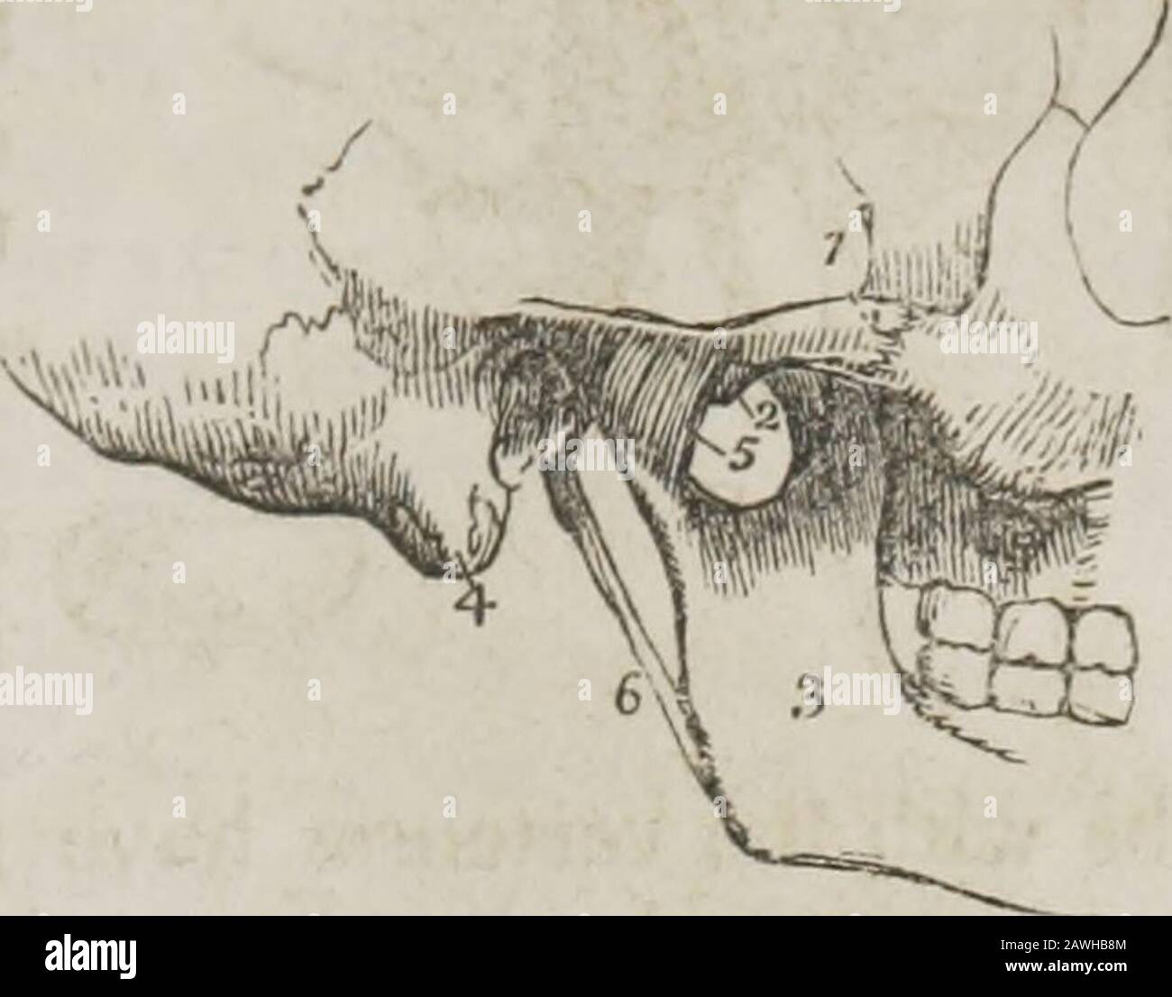 Ein System der menschlichen Anatomie, allgemein und speziell . nterartikulärer faseriger Knorpelgewebe, und twosnoviale Membranen,- externe laterale, innere laterale, Kapslar. Interartikuläre faserige Knorpelgewebe, Zwei synoviale Membranen. Das externe laterale Ligament ist ein kurzes und dickes Faserband, das schräg nach hinten vom Tuberkel des Zygoms zur * HINTEREN Ansicht der Bänder verläuft, die den Atlas, die Achse und den Okzipitalknochen verbinden. Der hintere Teil des Occipitalknochens wurde weggesägt, und die Bögen aus Theatlas und Achse wurden entfernt. 1. Der überragende Teil des Occipito-axoiden Bandes, das Stockfoto