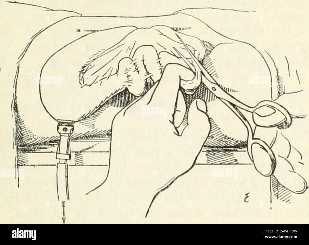 Der Practitioner . ces by Darm crings, or the fingers of Assistant placate back to back, with sizing interval between.A short incision is made incision into the darm, and a Handtasche-stringsuture of feiner Seide eingeführt round the ranges of the apertureas may incloce all the coats at the margin. Anschließend wird das Zentralrohr in diese Öffnung und die Ringsauge draTi fest eingesetzt, um die Ränder des Apertureins auf den Darm über den Flansch der Röhre aufzutragen. Wenn der Faden für die bloße Voreinaryenterostomie in einem Bogen festgebunden sein kann. Dann wird der äußere Federknopf über das andere Ende des t geführt Stockfoto