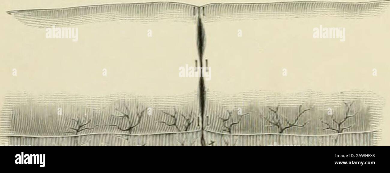 Operative Chirurgie. ", J! :;:r;^ i   Abb. 873.-Darm-Eeseetion, Halsteds-Methode. Gummibänder und Drucknaht in Position. HaUteiVs Methode der Resektion.-Der zu resezierende Teil wird in der vorhergehenden Instanz isoliert, und der Inhalt wird beiseite geschoben und zurückgehalten, um den Darm herumgetragen und durch Schleifen befestigt (Abb. 873). Die Linien des Einschnitts sind so weit entfernt, dass sie für jedes Ende des arteriellen supplywhich, das sorgfältig vor Verletzungen geschützt ist, gesichert werden. Beforeremoval wird mit der Vorauswahl von U-turen begonnen, normalerweise sechs in der Zahl, eingeführt, nur ou Stockfoto