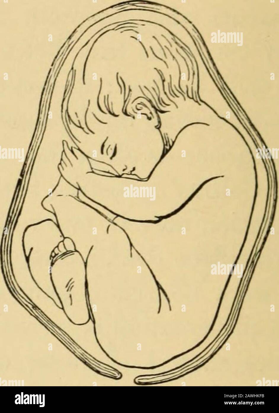 Ein System der Geburtshilfe . Abnorme Form der Uterushöhle, das Ergebnis des deformierten Beckens (Simpson). Eine Breech-Präsentation, das Ergebnis einer abnormalen Form der Uterus-cav-ITY (Simpson). Auch hier sind bei versehentlichen oder permanenten Änderungen in der Form der Tau-Erin-Kavität anormale Darstellungen bei der Arbeit sehr häufig. Auf diese Weise können wir die Fehlbildungen erklären, die in mühseliger Arbeit durch fibroide Tumoren der Gebärmutter, Defizitäten des Beckens, Plazenta prsevia, Überschuss an Liquor Amnii und andere anormale Bedingungen auftreten. So werden Fälle gemeldet, in denen dieselbe Frau in allen von steht Stockfoto