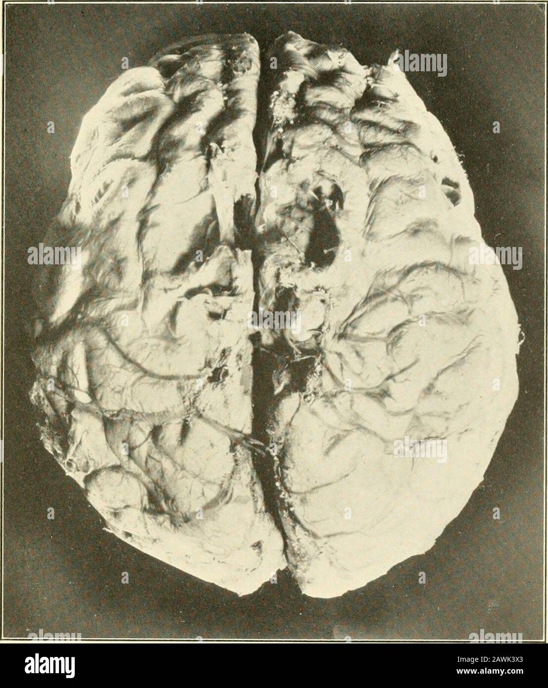 Geriatrie: Die Krankheiten des Alters und ihre Behandlung, einschließlich physiologischer Alters, häuslicher und institutioneller Pflege und medico-rechtlichen Beziehungen. Gnosis.Of the General Neuroses senile Tremor und Lähmung agitans aremost frequent, und Neurasthenie wird manchmal gesehen. Vertigotritt im Alter ziemlich häufig auf und ist fast immer an einer Tozerebralen Arteriosklerose erkrankt. Von den Psychosen sind Melancholia andhypochondrie häufig, gelegentlich kommt es zu einer Amentia orparanoia, selten zu Manien. Ihre Diagno-sis ist kaum schwierig. Demenz ist das übliche Ergebnis der Psychosen von Alter und Termi Stockfoto