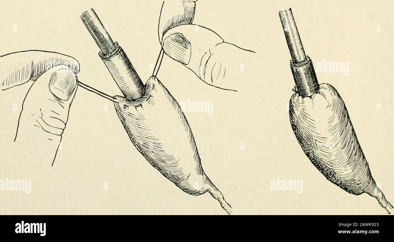 Die Praxis der Chirurgie. Ion von Dawbarns Methodologie zur Cholezystostomie (Mayo inKeens Surgery). 178 THK AUDOMEN zur Flucht. Um den Stumpf zu diaiii, stecke in ihn, mit Nr. 00 Phiincatjiut, ein Gummirohr, das mit Gaze umgeben ist und durch Astabewunde herausführte. In sechs bis zehn Tagen wird das Katgut absorbiert, wenn der Abfluss entzogen werden kann, und ein fistelhafter Trakt hinterlassen, der spontan heilt. Die einfachen Manöver, die bereits beschrieben wurden, erklären oder erklären nicht die Behandlung solcher Komplikationen, wie zahlreiche Steine in den Kanälen, Stein in der Ampulla von Vater, Adhäsionen, Jistulce und malignes di Stockfoto