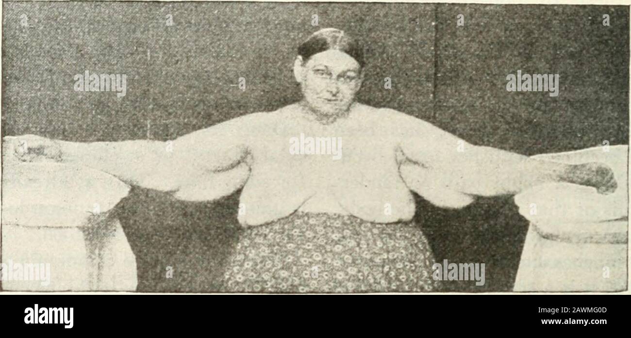 Adiposis Dolorosa Stockfotos und bilder Kaufen Alamy