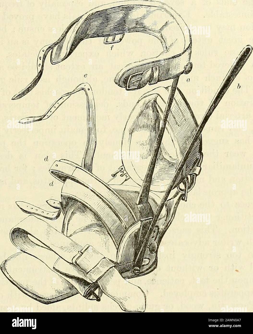 Ein chirurgischer Eingriff: Theoretisch und praktisch . nicht zu lange in einer Position gehalten, bis die Kraft, die Zehen zu senken und den Fuß umzukehren, verloren ist; oder, anders gesagt, ein Valgus wird im Austausch für den varus erzeugt. Dieser sekundäre Tibialgus wurde auf die nichtunion der abgetrennten posterioren Tibihne zurückgeführt. APPARAT FÜR VEREINSFUSS. 241 Das Liegt wirklich an der zu langen Aufbewahrung des Fußes in einem entführten Apparat.Wir haben ihn bei Kindern beobachtet, die mit varus geboren wurden und die mit der Withoutoperation behandelt worden waren. Seine Produktion wird von der gleichen Verfassung begünstigt Stockfoto