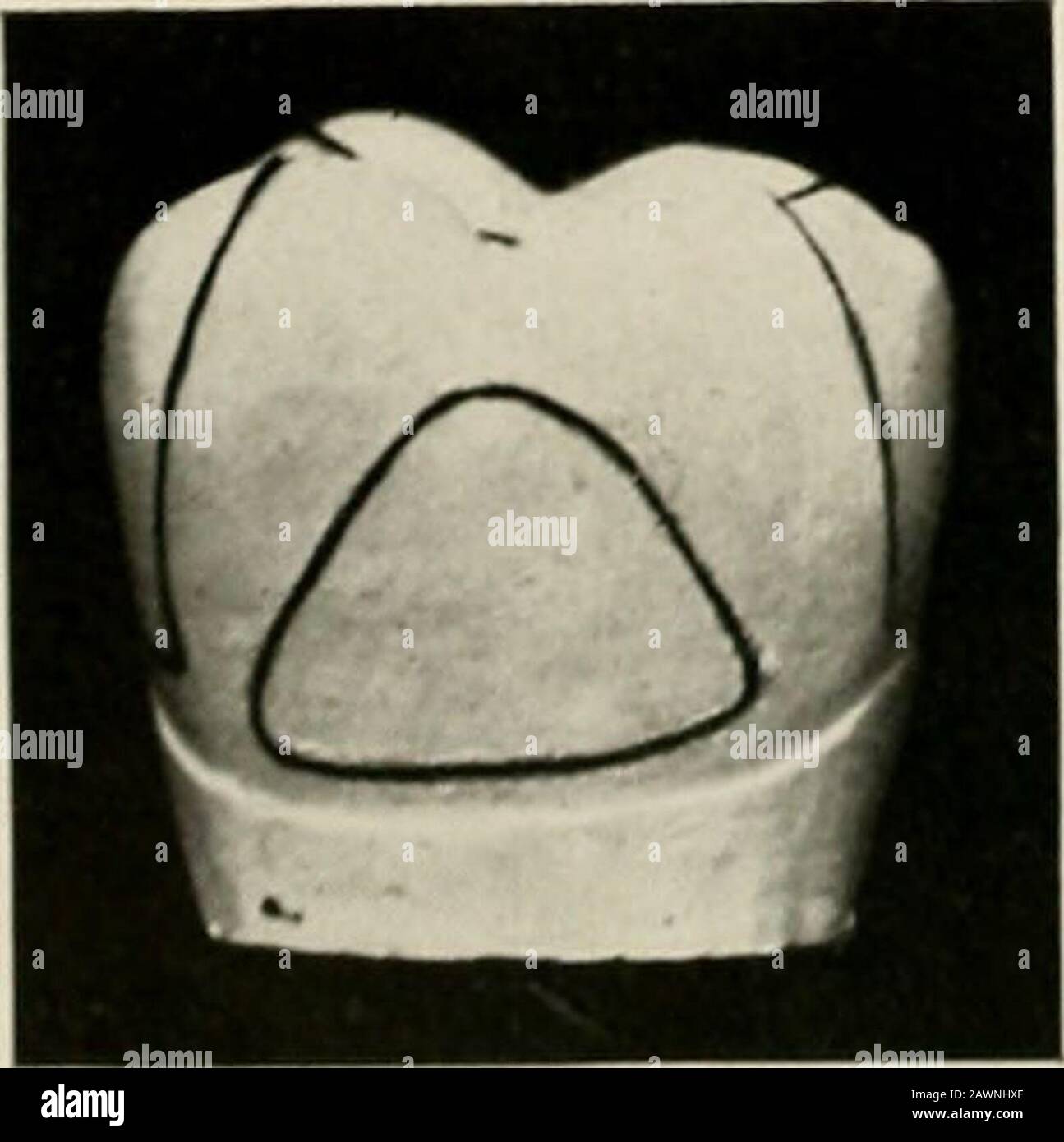 Technik und Umfang von Gussgold- und Porzellaneinlagen; mit einem Kapitel über Endokrinodontien oder die duktlosen Drüsen - ihre Expression im menschlichen Mund. FI-. N2. Abb. s;]. Also Tanne. SI. FI- S.J Abb. Si;. &lt;^vr^^• IltKiAitATiox &lt;)!) EIN Mesio-Djsto-Occlusal (avitv IX AX Ti-pek ^Molai;, alsoa Buccal Cavity ix der SAJri;-Zahn. Abb. 79-Viow aus der lic 1.ureal-Kavität. Lack- und Verformung der Oberfläche beachten. FI.l;-. !S().-icv von occlusa! Oberfläche der Kavität, auch slunviigmesial und distal ] iarts davon. Abb. 81.-Distale Kavität, die auch die Okkusalebenen zeigt. Die Abbiegeflächen aller Flächen und beachten Stockfoto