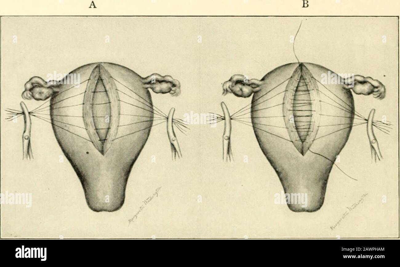 Ein Lehrbuch der Geburtshilfe . breite Bänder; die Vorbereitung von Peritonealklappen; Amputation der Gebärmutter; die Ligation der Gebärmutter; und das Übernähen des Stumpfes, das fallengelassen wird. Die Bauchwand kann durch Nahtstellen, unterbrochen, geschlossen werden;-s4 OBSTE TRIL OPERA 770AS. Nähte,-der einfachste Plan für einen Anfänger,-oder durch ein paar durchlaufende, unterbrochene Silkworm-Darm-Nähte, die zu einem einfachen Splinten der Wunde führen - das Peritoneum, die Faszie und die Haut werden durch getrennte Nähte des Darms vereint. Die Technik des Sanger ist bis zum Punkt, an dem das Kind steht, gleich Stockfoto