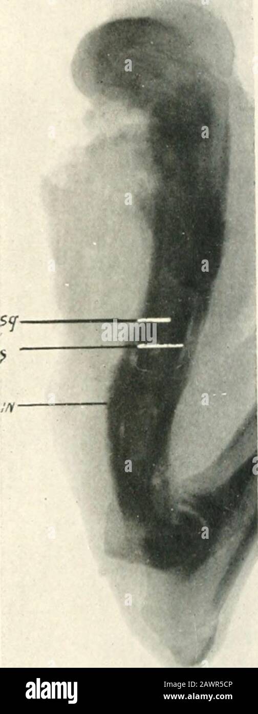 Studien aus den Labors der Abteilung Chirurgie. ^^^ Pic. I.-Kreislauf von Säuglingen tiVjia und Fibel. (Nach Lexer.) A, Nährstoffarterie; B, Metaphyseal- und Kapselarterien; C. relative avaskuläre Zone, in der die Sequestrum-Trennung normalerweise auftritt. Abb. 2 (Pfad. Nr. 5665).-Opera-tion, 10. Oktober. Im Jahr 1919. Verfahren:Kapillarröhrchen mit Krotonöl, das in den medullären Kanal eingesetzt wurde.Ergebnis: Getötet 3. November 199.Sg, sequestrum; Iji, involucrum;S, Trennungszone. Agar. Da Croton-Öl eine deutliche Nekrose des surrzenden Knochens verursacht, ist wevere in der Lage, eine chemische Osteomyelitis zu erzeugen. Ein Secjuestrum oft Stockfoto