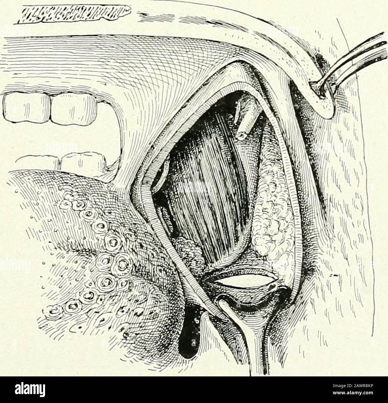 Chirurgische Therapeutika und operative Technik . ?&gt;^^/-y. Abb. 274,-Rechts Tonsillar Fossa, von der Innenseite aus gesehen. Die styloide Apophyse, die Styloidmuskulatur und die überlegene Einengung von j)Liarynx wurden haveziert. Exposition von Sprachnerv, innerem Pterygoid und Digastrimuskulatur und Gesichtsarterie, die in das celhilo-adipale Gewebe des themaxUlo-pharyngealen Raums abtaucht. Abb. 275.-Rechts Tonsillar Fossa, von der Innenseite aus gesehen. Ein Retraktor hat die Muskel- und Gesichtsarterie des Diastrens zurückgehängt und den unteren Winkel der Tonsillarwunde gewaltsam nach unten gezogen. Diese^-Ositionena Stockfoto