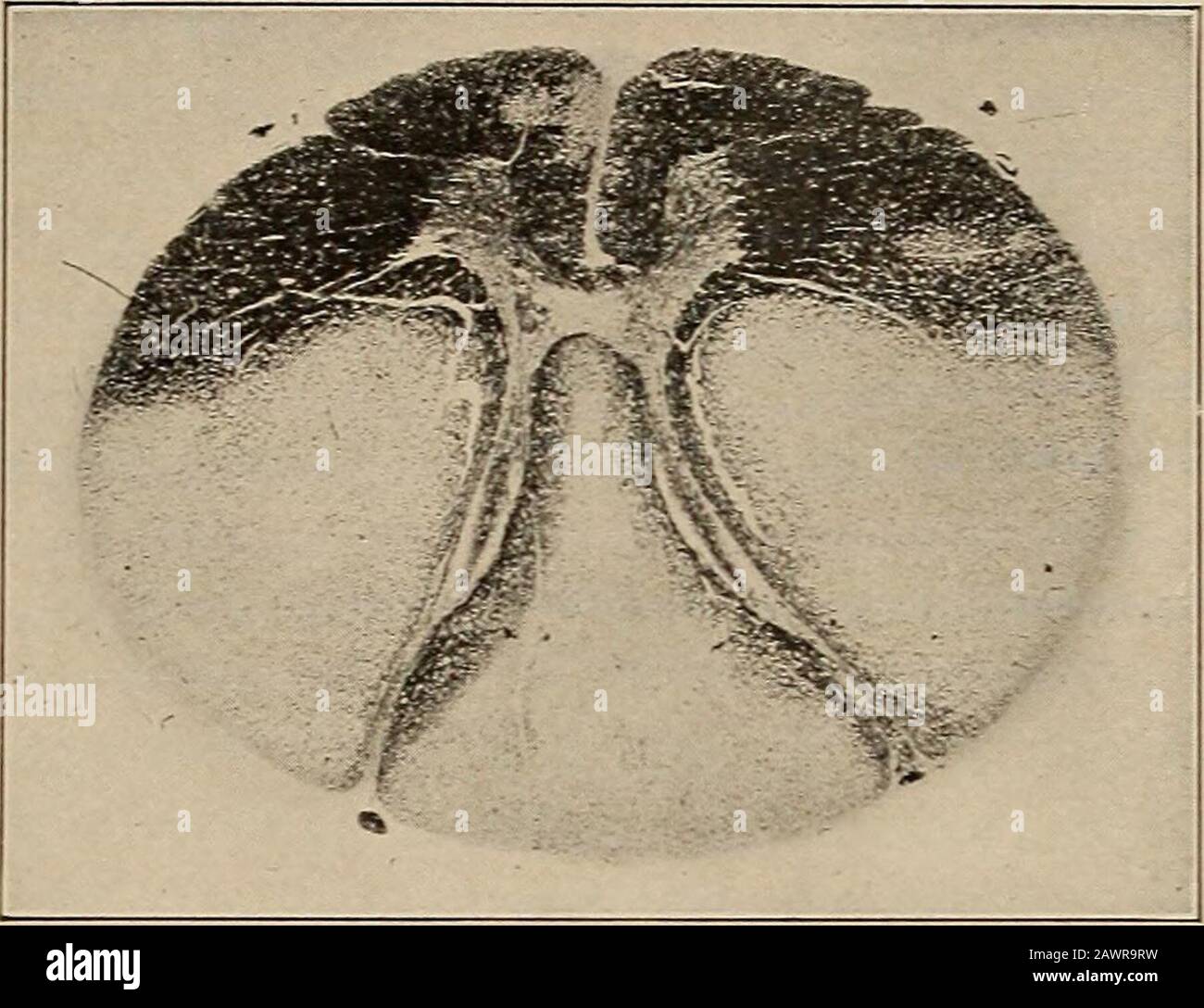 Nervöse und mentale Erkrankungen. O die Hyperexcitabilitv von thereflexes, Massage ist manchmal nicht gut getragen. Allgemeine Maßnahmen, die auf die körperliche Gesundheit und die mentale Ruhe dieser Patienten hindeuten, addto ihren Komfort und die Länge des Lebens. Der Blasenzustand sollte eine konstante Wachsamkeit erhalten, da sich ein hohes Maß an Retention entwickeln kann, ohne dass die Patienten dies bemerken. Kombinierte CORE-LÄSIONEN IN ANEMIAS UND CACHEXIAS.Nonne war der erste, der entschied Veränderungen der Spinalkordinfälle von perniziöser Anämie zeigte. Ähnliche Veränderungen in der Retinasie waren bekannt, und Apparentl Stockfoto