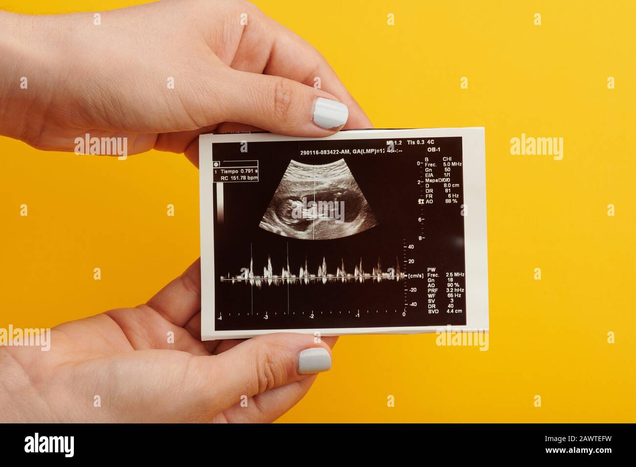 Ultraschalluntersuchung eines gesunden Babys bei Schwangerschaftsuntersuchung Stockfoto