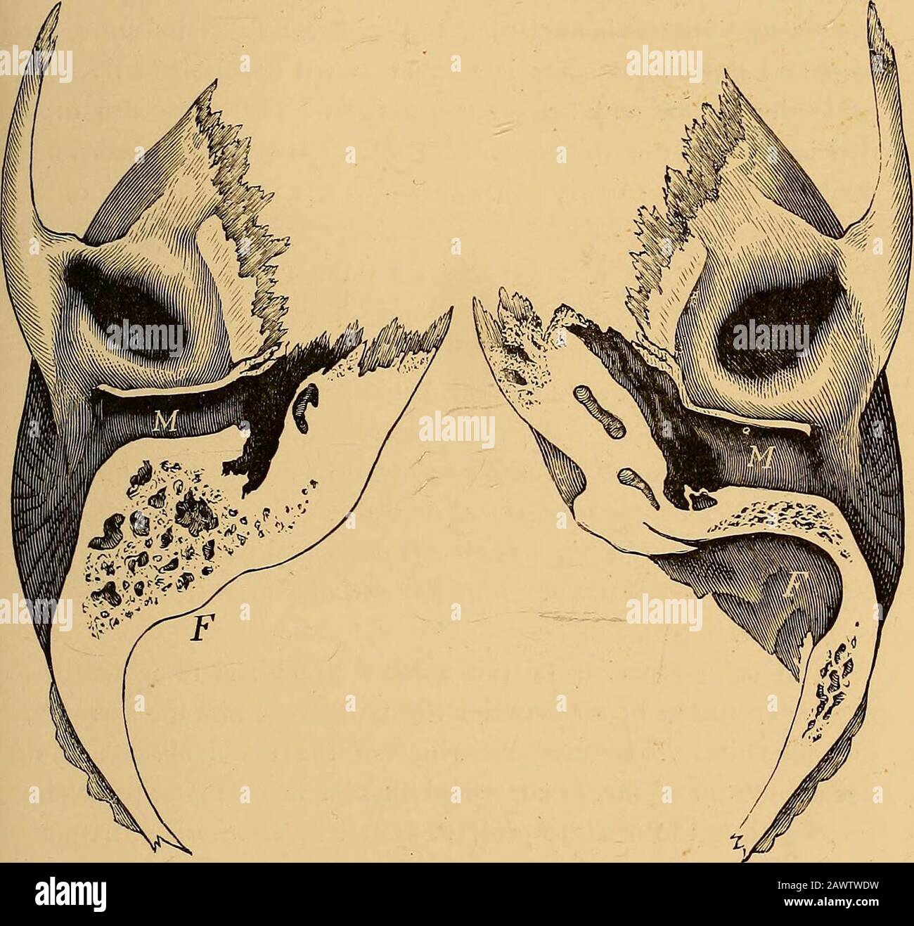 Die Erkrankungen des Ohres und ihre Behandlung . Origin.No Änderungen werden im Tympanon durch Entfernung des Glosso-Pharyngeals oder durch Extirpation des übergeordneten Halsganglions verursacht. Posteriorly und extern ist die Tympanhöhle connectedwith die Luftzellen des Mastoid-Prozesses, die, bevor sie in das Tympanon gehen, eine gemeinsame Höhle bilden, das Antrum mastoideum.Es liegt am hinteren und oberen Teil der inneren Hälfte der ERKRANKUNGEN DES MITTELOHRS. 125 osseous meatus, und wird von ihm durch eine ossige Schicht 3-4 mm dick getrennt. Die Luftzellen erstrecken sich über den gesamten Mastoid-Prozess und sind es Stockfoto