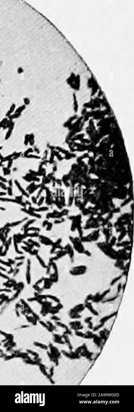 Grundlagen der Bakteriologie; eine kurze und systematische Einführung in die Erforschung von Bakterien und verwandten Mikroörganismus. Abb. 52.-Bacillus von Glycerin-Agar-Agar(Xiooo) (Frankel und Pfeiffer). Tuberkulose. Differenziert in der Färbung, nach Pap-penheims-Methode. Bacillus von Glanders (Bacillus Mallei (Loffler-Schiitz);Rotz-Bacillus).-Ursprung.-In den farcy-knospen oder Littlenodulen der Krankheit, von Loffler und Schiitz, im Jahr 1882. Bilden Sie.-Kleine schlanke Stäbchen, etwa die Größe des Tubercebacillus. Die Enden sind abgerundet. Niemals in großen Kol-lektionen erscheinen, in der Regel sündigen Stockfoto