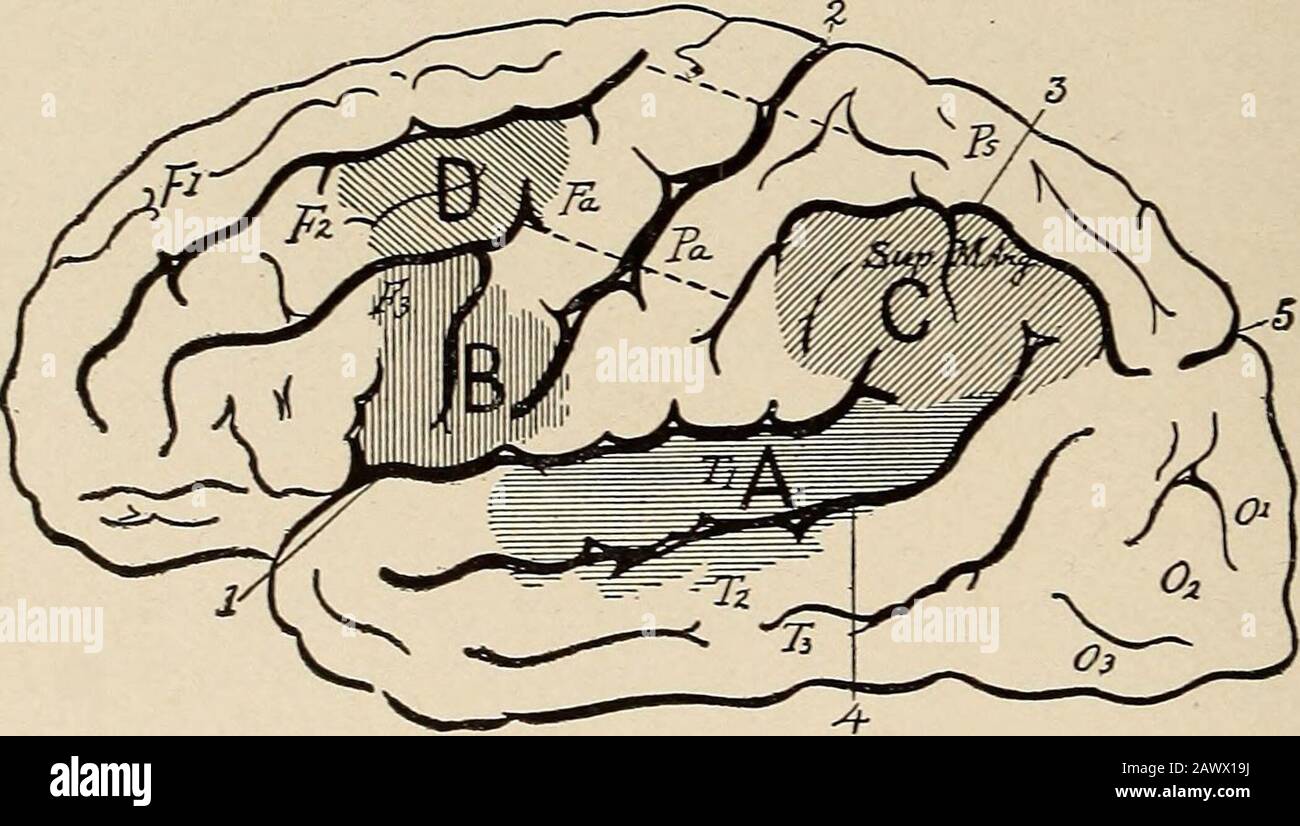 Nervöse und psychische Erkrankungen. En und geschrieben. Die ersten sind afferente Wahrnehmungsqualitäten. Die zweiten beiden sind Efferentqualitäten des Ausdrucks. Wir haben daher vier Wortgruppen: (1) Solche von Ton oder Hörvermögen; (2) solche von Sicht oder visuell;(3) solche von Bewegungen, die notwendig sind, um Worte in Sprache, Sprache und Sprache auszudrücken, und (4) wahrscheinlich die Bewegungen, die erforderlich sind, um diese durch schriftliche Symbole, Grafikmotor auszudrücken. Für diese vier Gruppen havefour kortikale Bereiche, wie in Abb. gezeigt. 71, S. 174, wo diese Wortmerkmale hauptsächlich dargestellt werden. Der Sprechbereich von Stockfoto