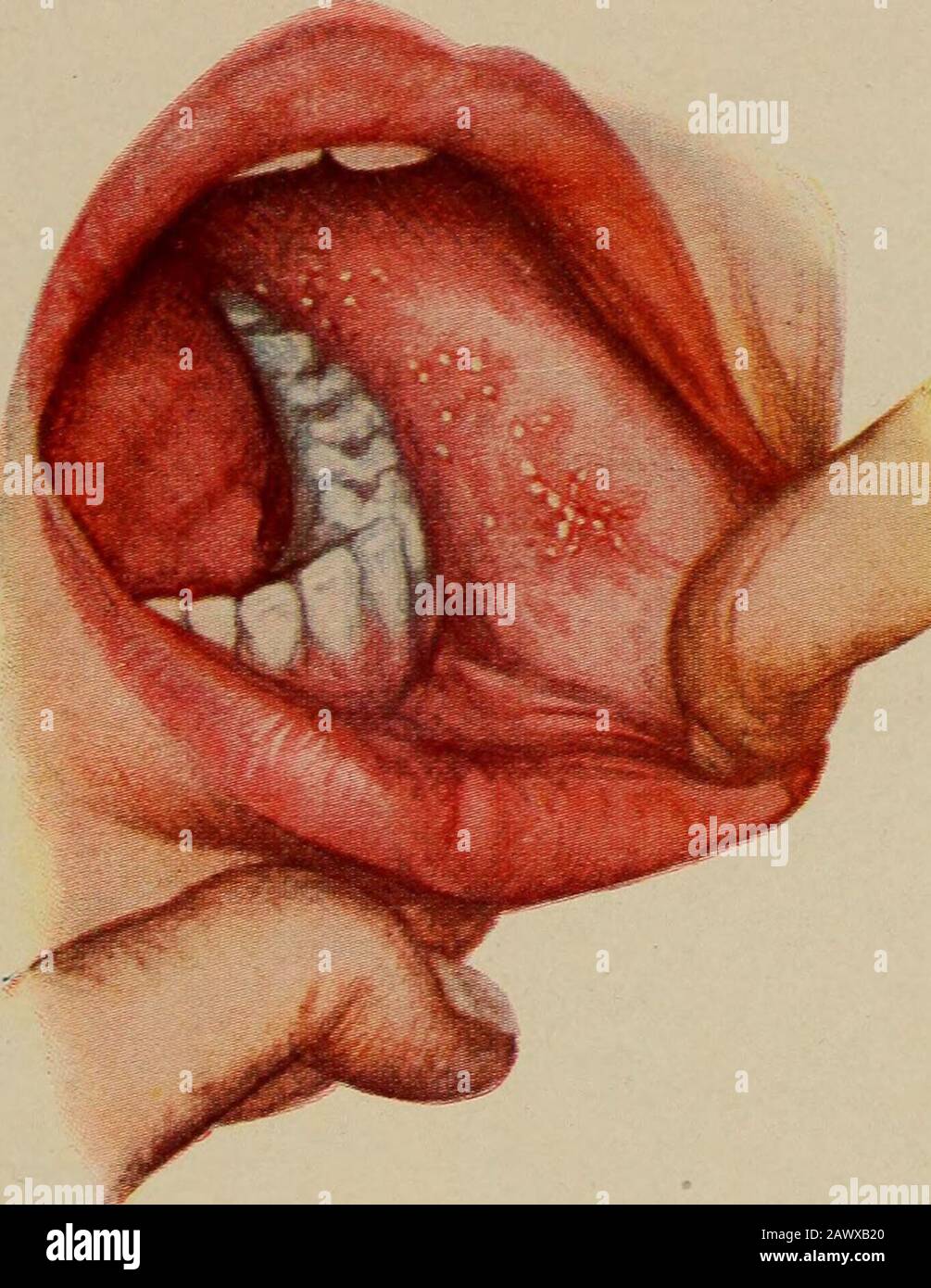 Erkrankungen von Kindern für Krankenschwestern . hygienische Bedingungen und ist gekennzeichnet durch einen Hautausschlag, Blutungen von den Schleimhäuten und durch tiefe Prostration. Komplikationen und Fortsetzungserscheinungen - Bei weitem überwiegen die Kapillarbronchitis oder die atarrhalalen Pneumoniaund Otitis Media. Auch Magen-Darm-Störungen, Cancrumoris, Tuberkulose und Lähmungen sind zu beobachten. Prognose.-Positiv. Komplikationen treten auf und machen die Prognose graviert. Die Usualmortalität ist niedrig. In Epidemien und in Krankenhäusern sind es zu Zeiten bis zu 30 oder 40 Prozent. Der Großteil der Todesfälle ist darauf zurückzuführen Stockfoto