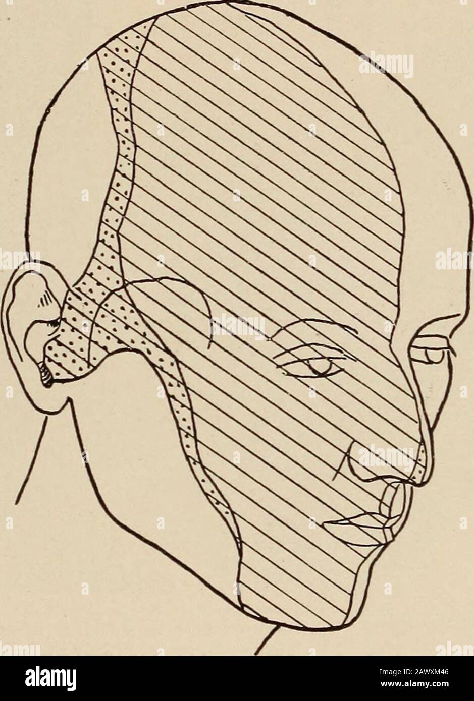 Nervöse und psychische Erkrankungen. Durch eine Tenotomie verursacht