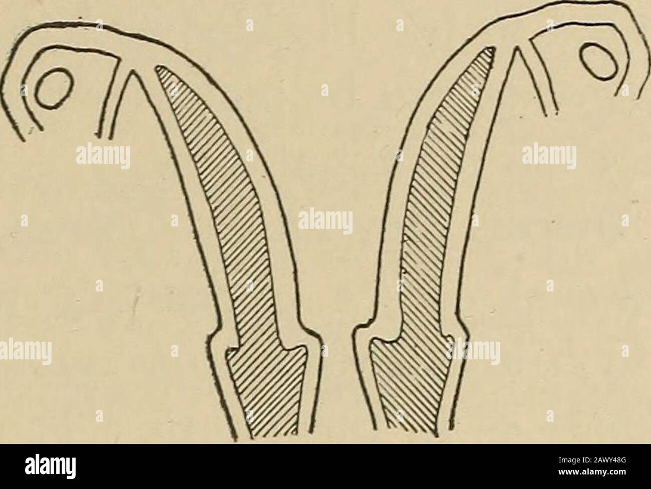 Gynäkologische Diagnose . Abb. 72.-Uterus Bipartitus. Abb. 73.-Uterus Didelphys. Stockfoto