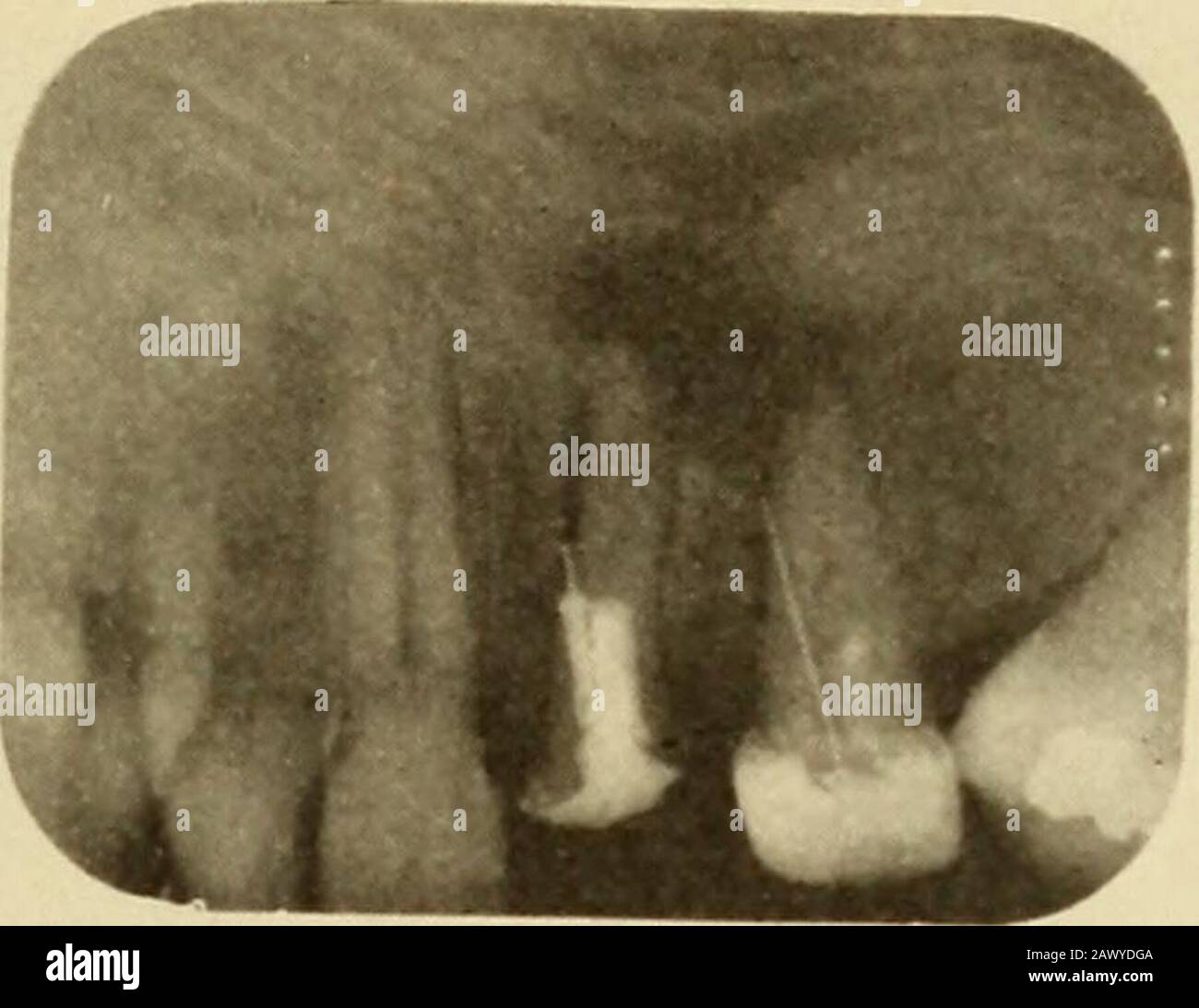Erkrankungen der weichen Zahnstrukturen und ihrer Behandlung; ein Textbuch für Studenten und Praktiker . die Behandlung und eine Pulpitis ora pericementitis wird durch den Vergleich der verschiedenen unter (Reneral Principles of Diagnosis) behandelten Symptome readih gemacht. I die Prognose einer perforierten Wurzel hängt ganz von den bestehenden UNFÄLLEN AB, DIE BEI DER BEHANDLUNG VON WURZELKANÄLEN 245 auftreten. Wenn die Perforation in einem leicht zugänglichen Bereich in einer starken, schallenden Wurzel und einer ifno suppurativen Infektion des Perikementums neu auftritt und lokalisiert werden soll, ist die Prognose eher günstig, WH Stockfoto