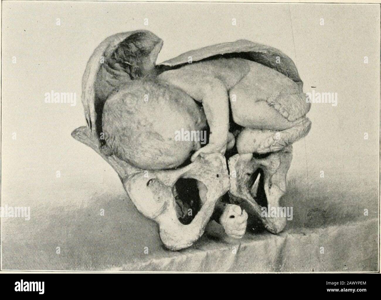 Ein Textbuch der praktischen Geburtshilfe, bestehend aus Schwangerschaft, Arbeit, Puerpal-Zustand und geburtshilflicher Chirurgie. Darstellung der Amtsleitung. Dorso-anteriore Position. Darstellung der Amtsleitung. Dorso-posteriore Position. MECHANISMUS DER ARBEIT. 121 Kopf nach rechts mit der rechten Schulter, in diesem Fall ist die ventrale Oberfläche des Fötus vorgelagert. Kopf nach links mit der linken Schulter, in diesem Fall ist die ventrale Oberfläche des Fötus vorgelagert. Kopf nach rechts mit der linken Schulter, in dem Fall ist die dorsale Oberfläche des Fötus vorgelagert. Gehen Sie zum linken Wi Stockfoto