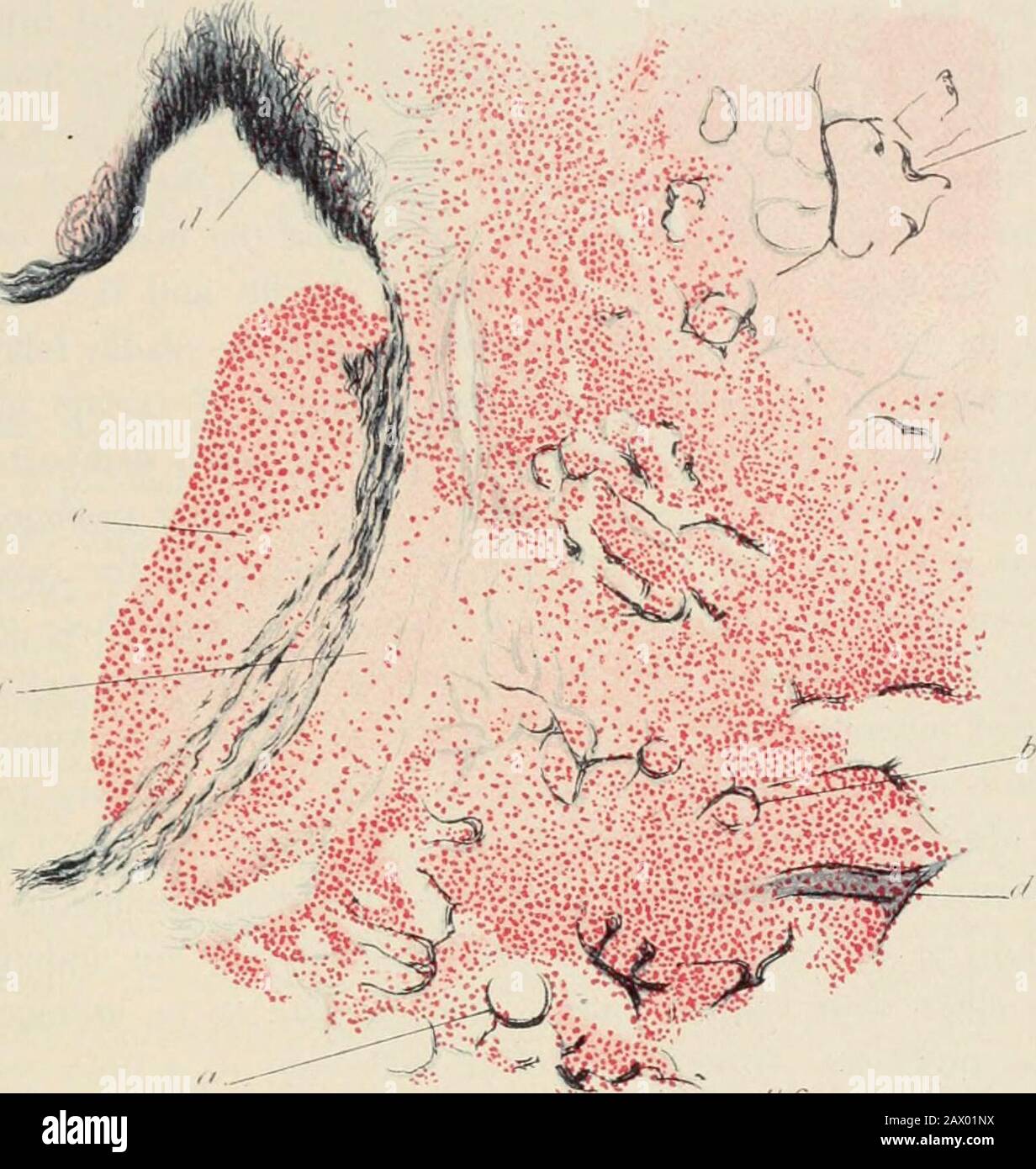 Praktische Pathologie; ein Handbuch für Studenten und Praktiker. Ranch der Arterie pulmc^nary, die Gelatinespritzmasse enthält.Um beide Strukturen herum gibt es eine gut markierte Zellproliferation und Infiltration; entlang der Linie von OPC wird eine ähnliche Infiltration beobachtet. Ein interlobuläres Septum.(/. Zentrale Kasusmasse des tuberkulösen Broncho-pneumonischen Pflasters. E. Koagulative Necrosen in Broncho-pneumonischen Flecken um den zentralen Bereich herum gesehen./. Frühe katarrhale Pneumonie. Beachten Sie, dass der zentrale Teil des Tuberkels jetzt entirelyavaskulär ist. Die Infektion geht selten in den Bereich der Coagulati über Stockfoto