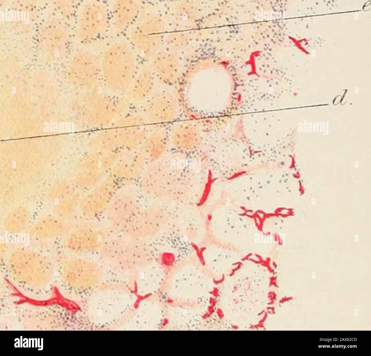 Praktische Pathologie; ein Handbuch für Studenten und Praktiker. Abb. 154. -Abschnitt einer Lunge, die von einer tuberkulösen Bronchopneumonie betroffen ist, die mit Gelatinkarmin injiziert wurde. Mit Alumhasmateinand van Giesons befleckt. ( x 50.) a. Bronchus mit katarrhaltiger Exsudation. D. Ast der Pulmc^näre Arterie, die Gelatinespritzmasse enthält. Um diese beiden Strukturen herum gibt es eine gut markierte Zellproliferation und Infiltration; entlang der Linie von C wird eine ähnliche Infiltration beobachtet. Ein interlobuläres Septum.(/. Zentrale Kasusmasse des tuberkulösen Broncho-pneumonischen Pflasters. E. Koagulative Necrosen siehe Stockfoto