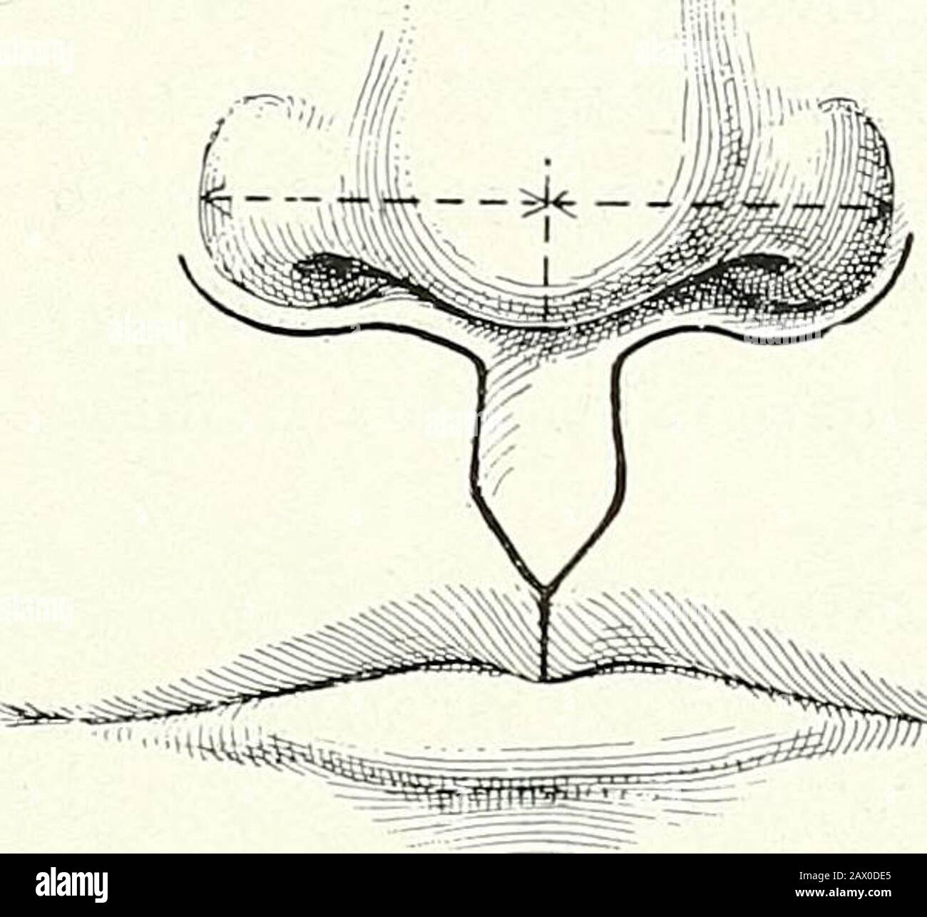 Chirurgische Therapeutika und operative Technik . Abb. 17.-^Einfach Bilaterajj Hake-Lip. Sehr breite Kerben; entartet die zur Koaptation notwendigen Schneidezähne. Abb. 18.-Einfaches Bilaterales Hare-Lip. Verschieben der seitlichen Klappen und Koaptation. Stockfoto