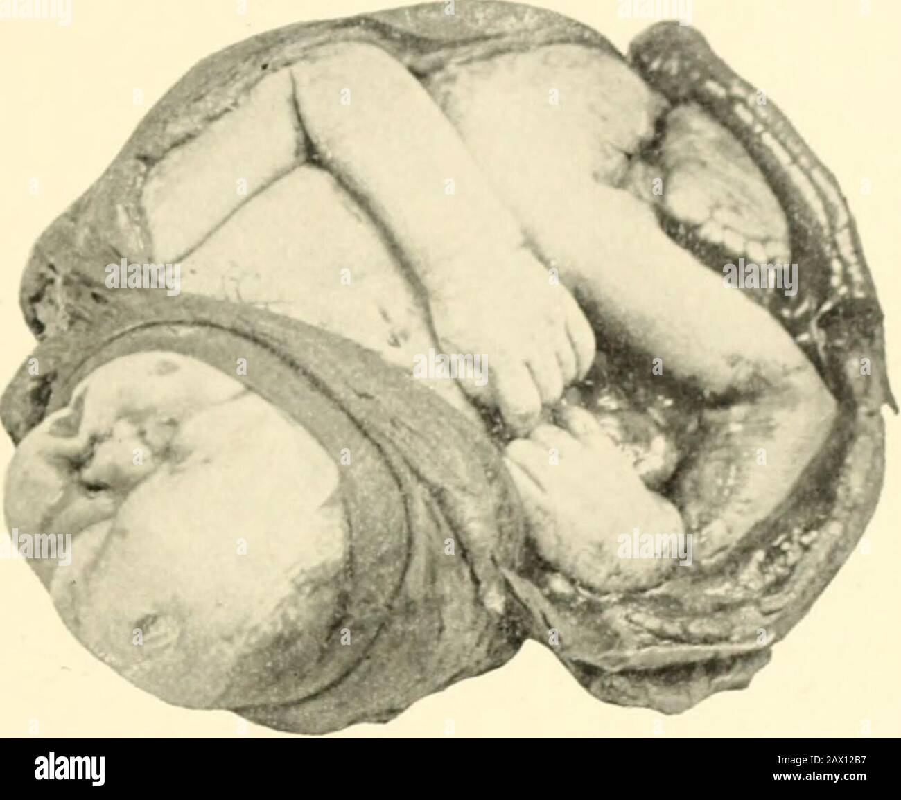 Ein Lehrbuch der Geburtshilfe . Abb. 224.-Gesichtsdarstellung, Kinn posterior; enorme Dehnung des Halses. Prognose.-Die fetale Sterblichkeit von Gesichtspräsentationen liegt bei 13 bis 15 Prozent. Die Sterblichkeit der Mutter steigt von weniger als 1 Prozent, in allen Laboren auf 6 Prozent oder mehr, wenn man in die Buchhaltung anteriorer und posteriorer Positionen und diejenigen, die in der allgemeinen Praxis aremissiert oder vernachlässigt wurden, eingreift. Behandlung.-Wenn das Kinn weit nach vorne gerichtet ist, kann es vorkommen, dass die Arbeit keine Interferenz erfordert. In den hinteren Positionen des Kinns ist die Thekase jedoch immer difficu Stockfoto