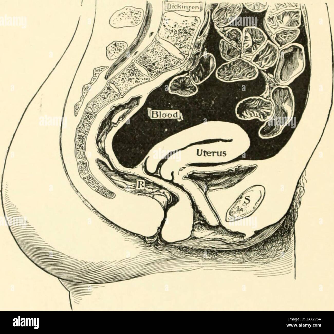 Uterine rupture uterus Fotos und Bildmaterial in hoher Auflösung Alamy