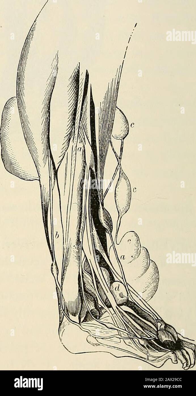 Die Pathologie und chirurgische Behandlung von Tumoren . Abb. 376.-Neurofibroma des Radialnervs am Handgelenk, von einer neunjährigen Frau (nach Sutton). Der Tumor sim-ulierte ein Ganglion. Abb. 377.-untere Extremität aus einem Fall mehrerer Neurofibromata; eine dritte natürliche Größe (nach Perls): A, oberflächlich peronal; b, Suralnerv; c, oberflächliche Zweige des saphenösen Majornervs; d, Tumor auf tiefem Peronal. Untere Extremitäten: Der Ischiasnerv unterhalb seines Austritts aus dem Pelvisis ist gelegentlich der Schrecken eines Neuroms, aber häufiger der Sitz des Neurosarkomas. IK-Nign-Tumore können in jedem Teil von auftreten Stockfoto